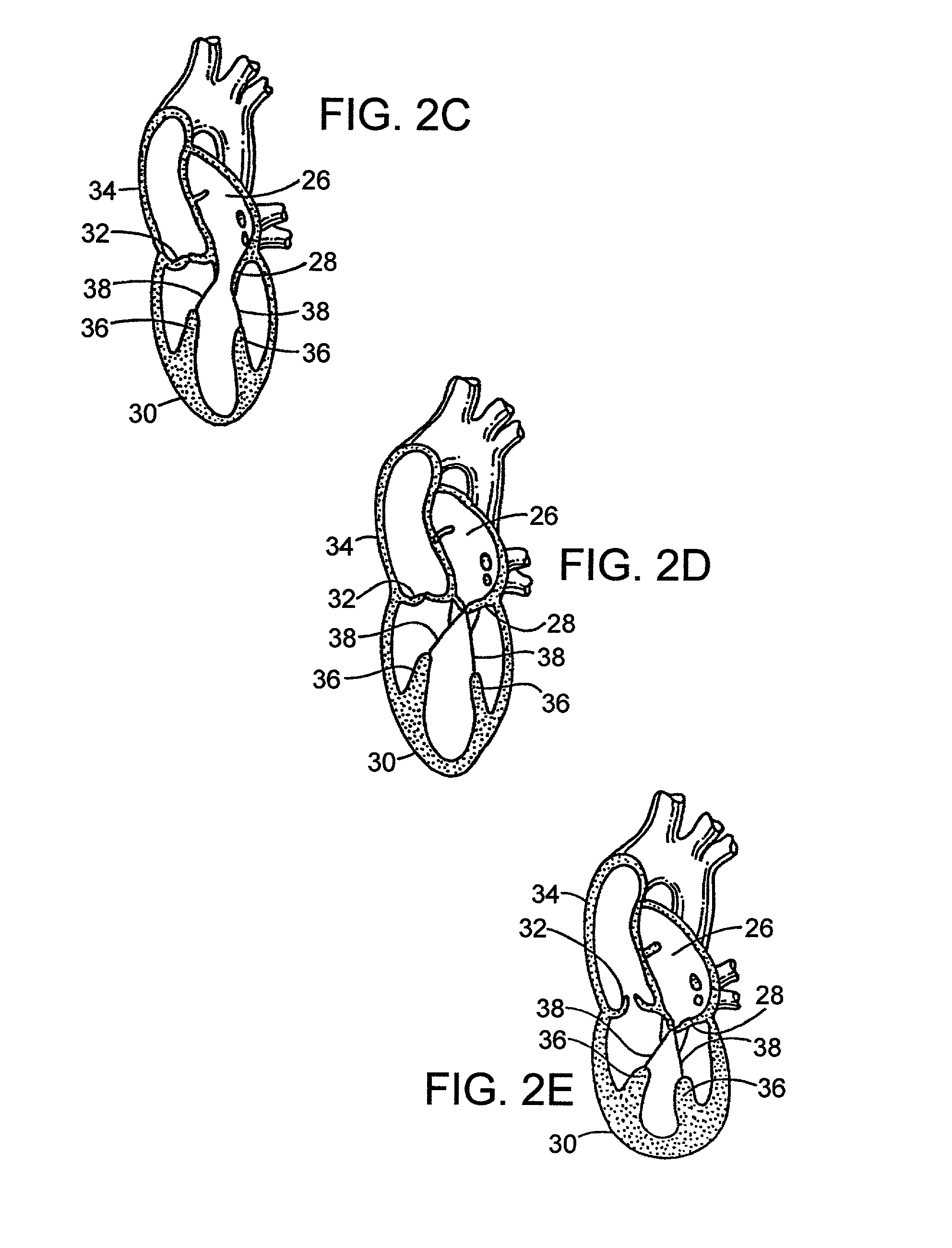 Device to permit offpump beating heart coronary bypass surgery