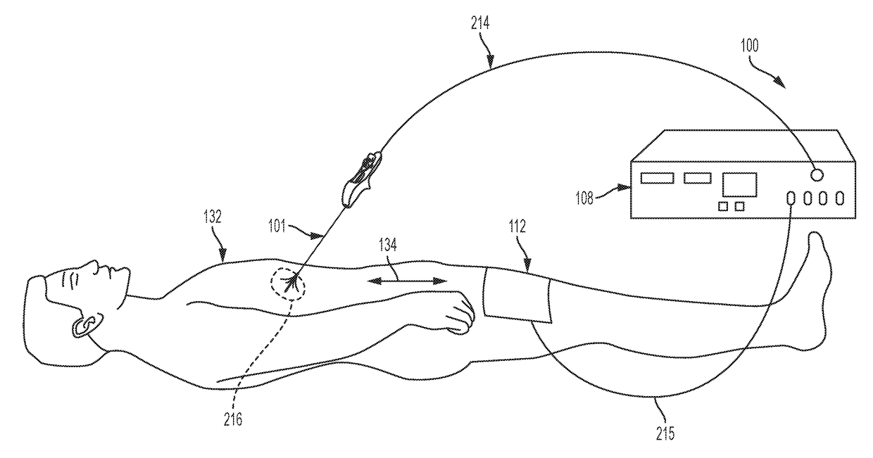 Techniques for irreversible electroporation using a single-pole tine-style internal device communicating with an external surface electrode