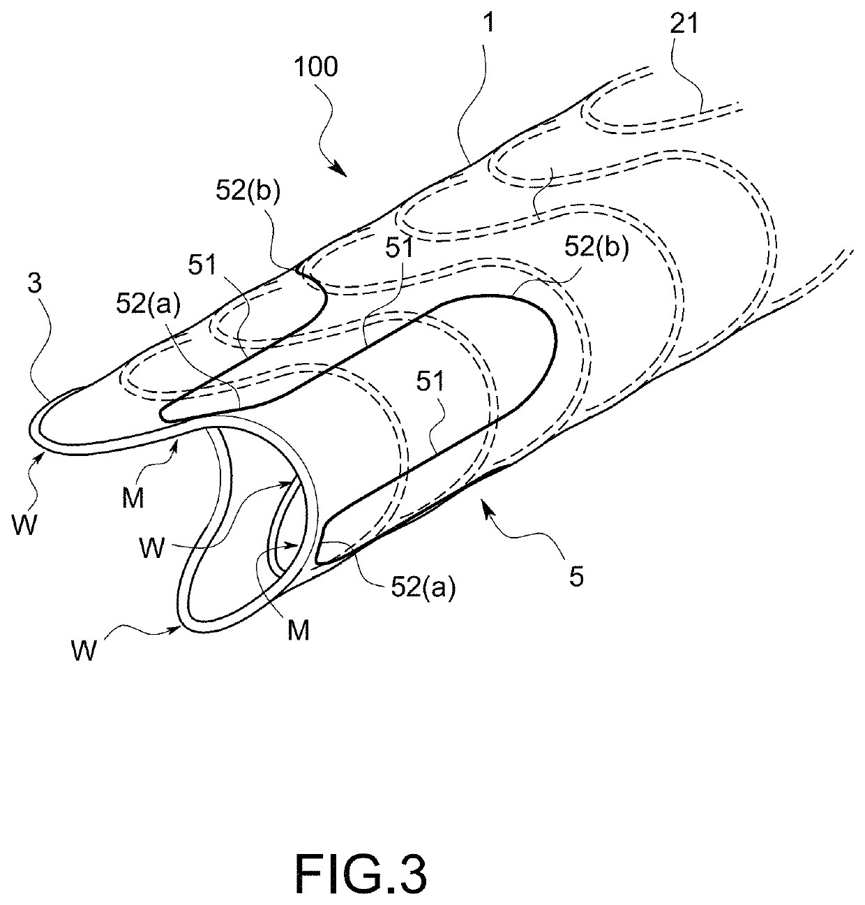 Stent-graft