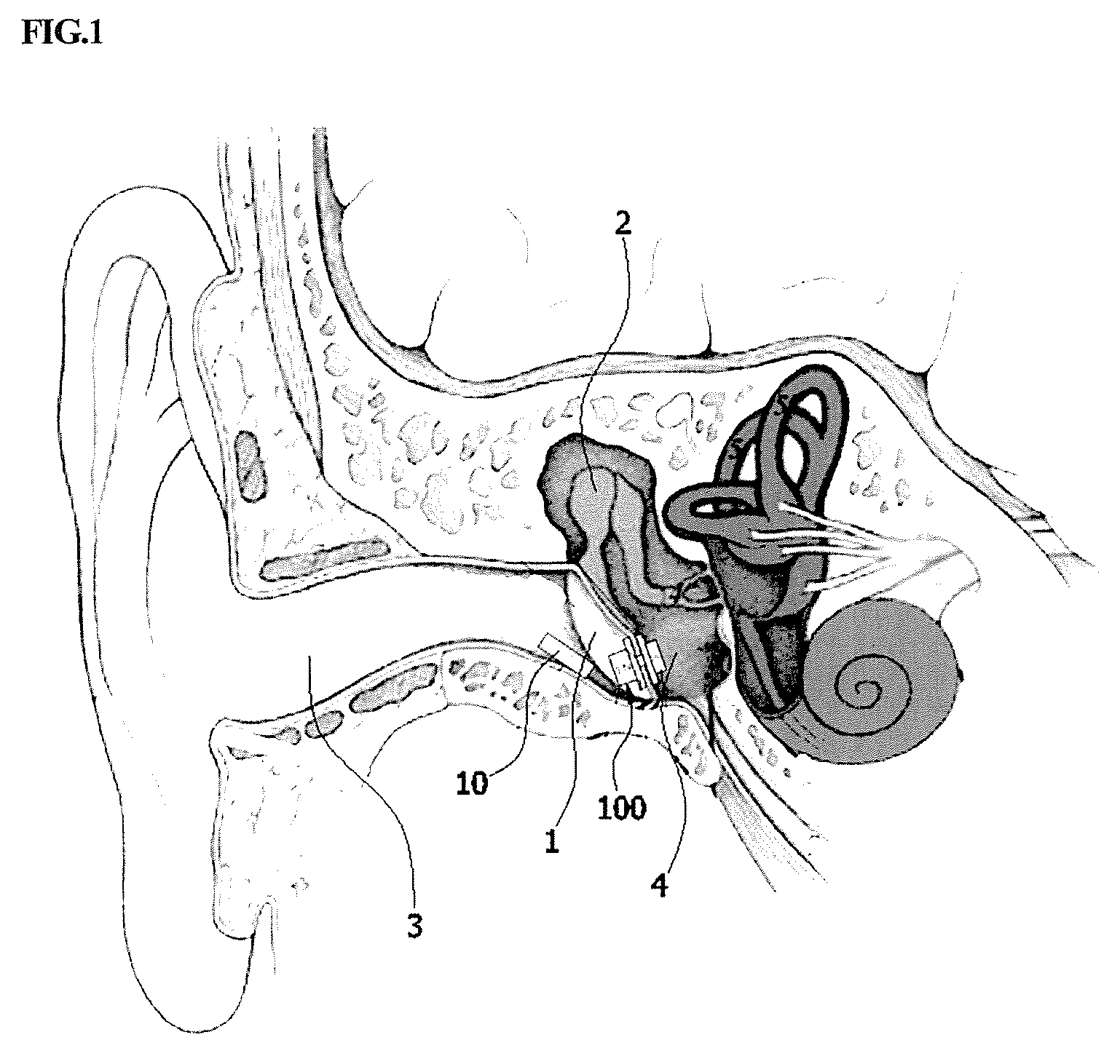 Transtympanic vibration device for implantable hearing aid and apparatus for installing the same