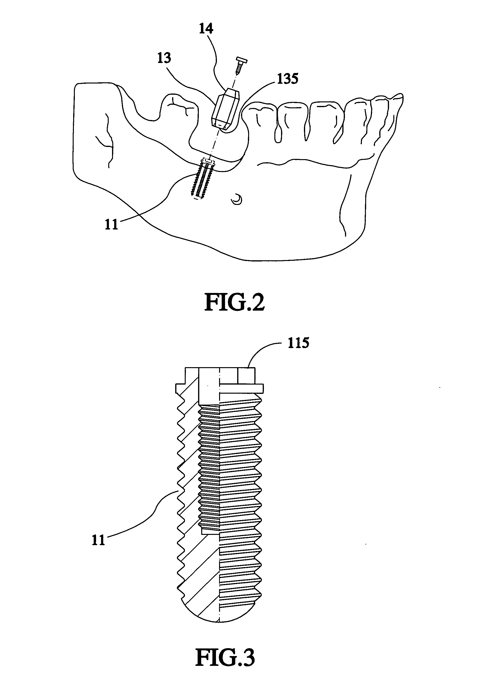 Method of designing dental-implant prosthesis