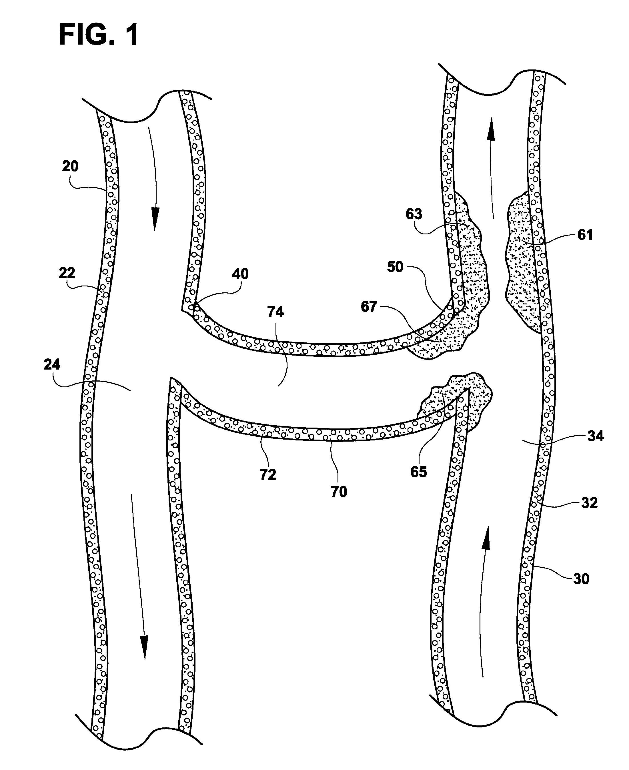 Method for Treatment of Complications Associated with Arteriovenous Grafts and Fistulas Using Electroporation