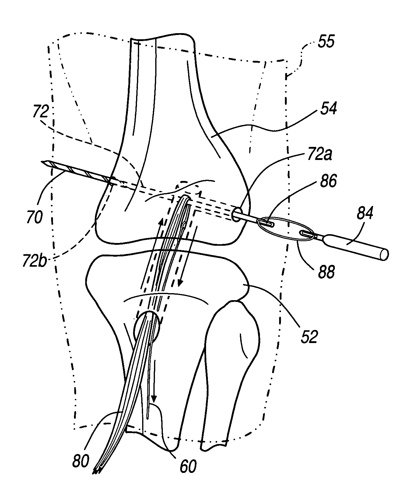 Apparatus and method for manipulating a flexible strand and soft tissue replacement during surgery