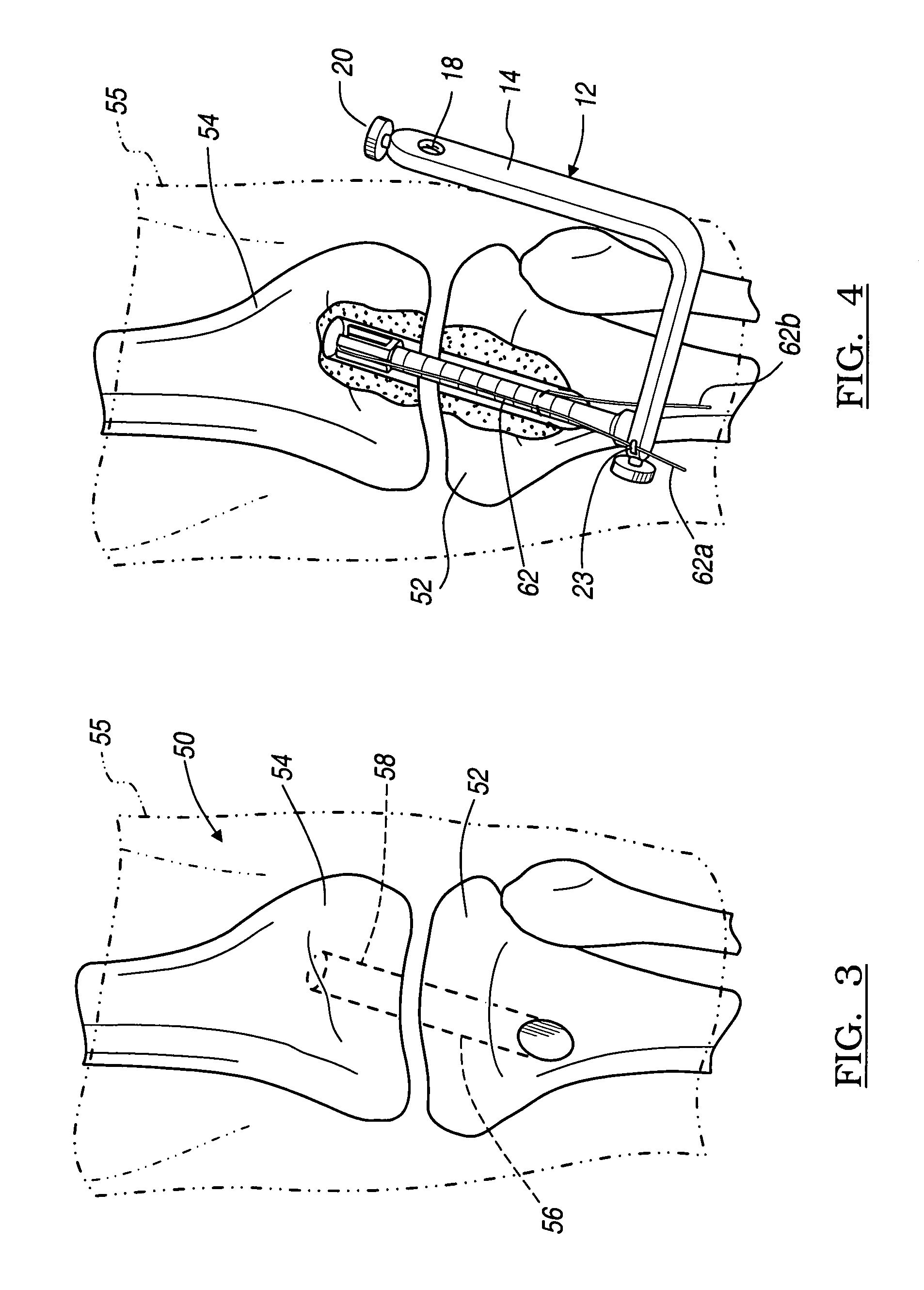 Apparatus and method for manipulating a flexible strand and soft tissue replacement during surgery