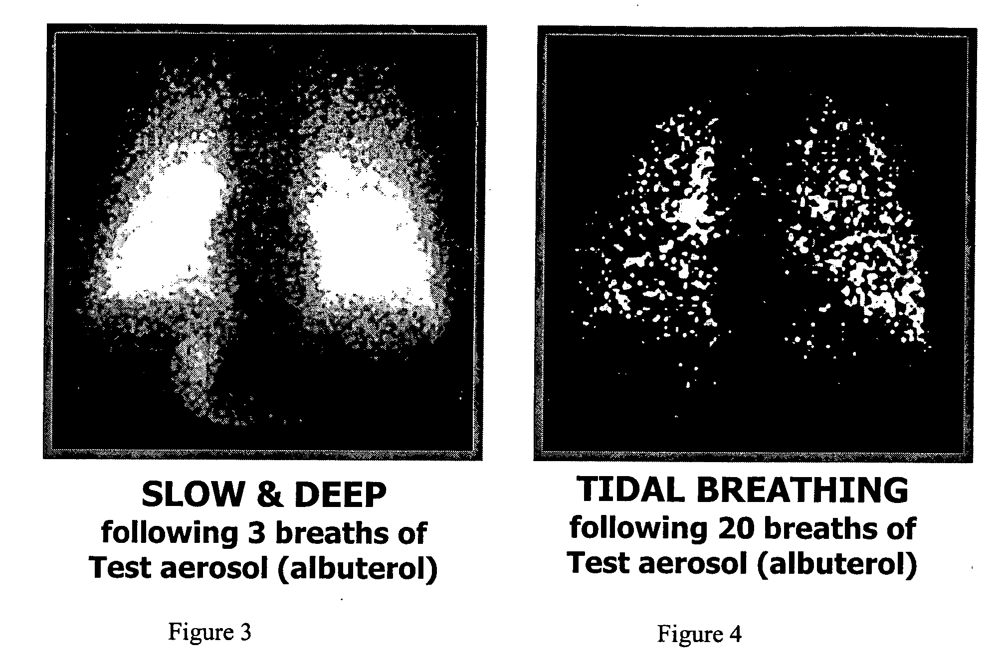 Method of treating pulmonary disease with interferons