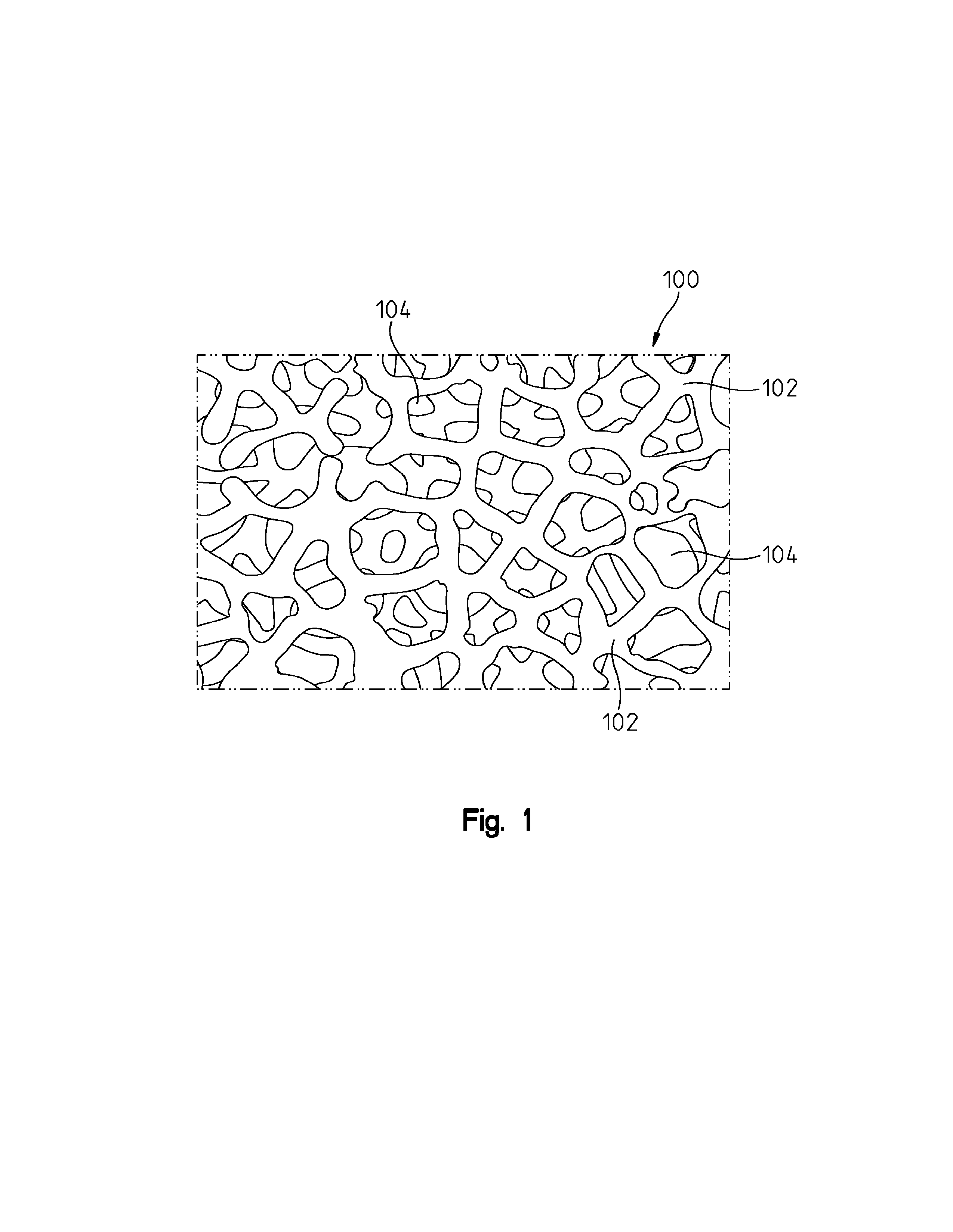 Porous metal implants with bone cement