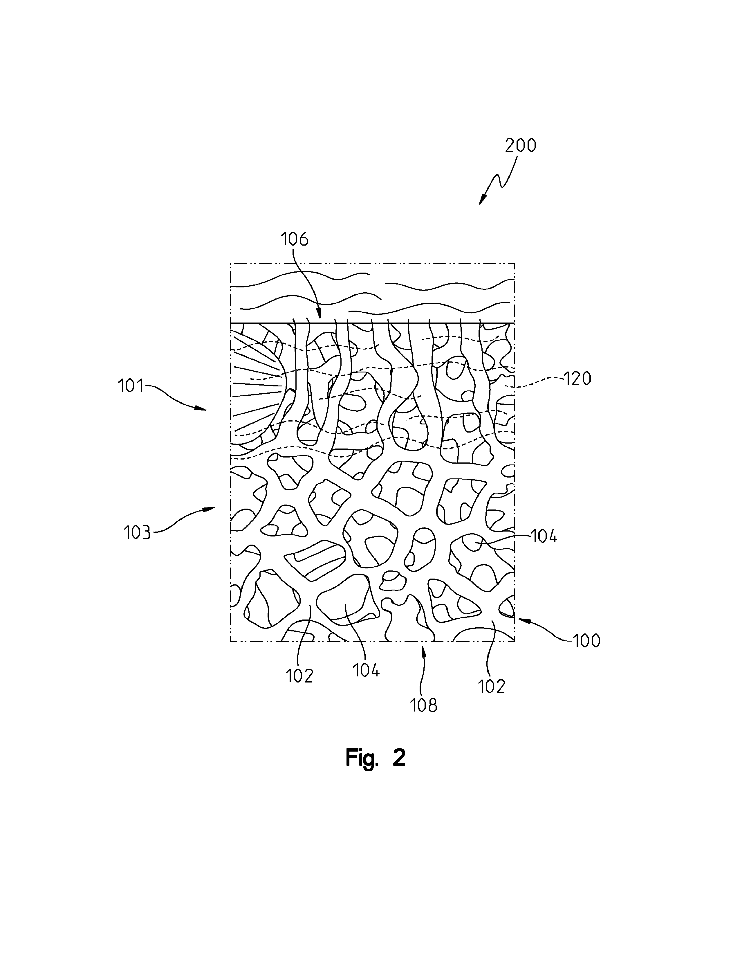 Porous metal implants with bone cement