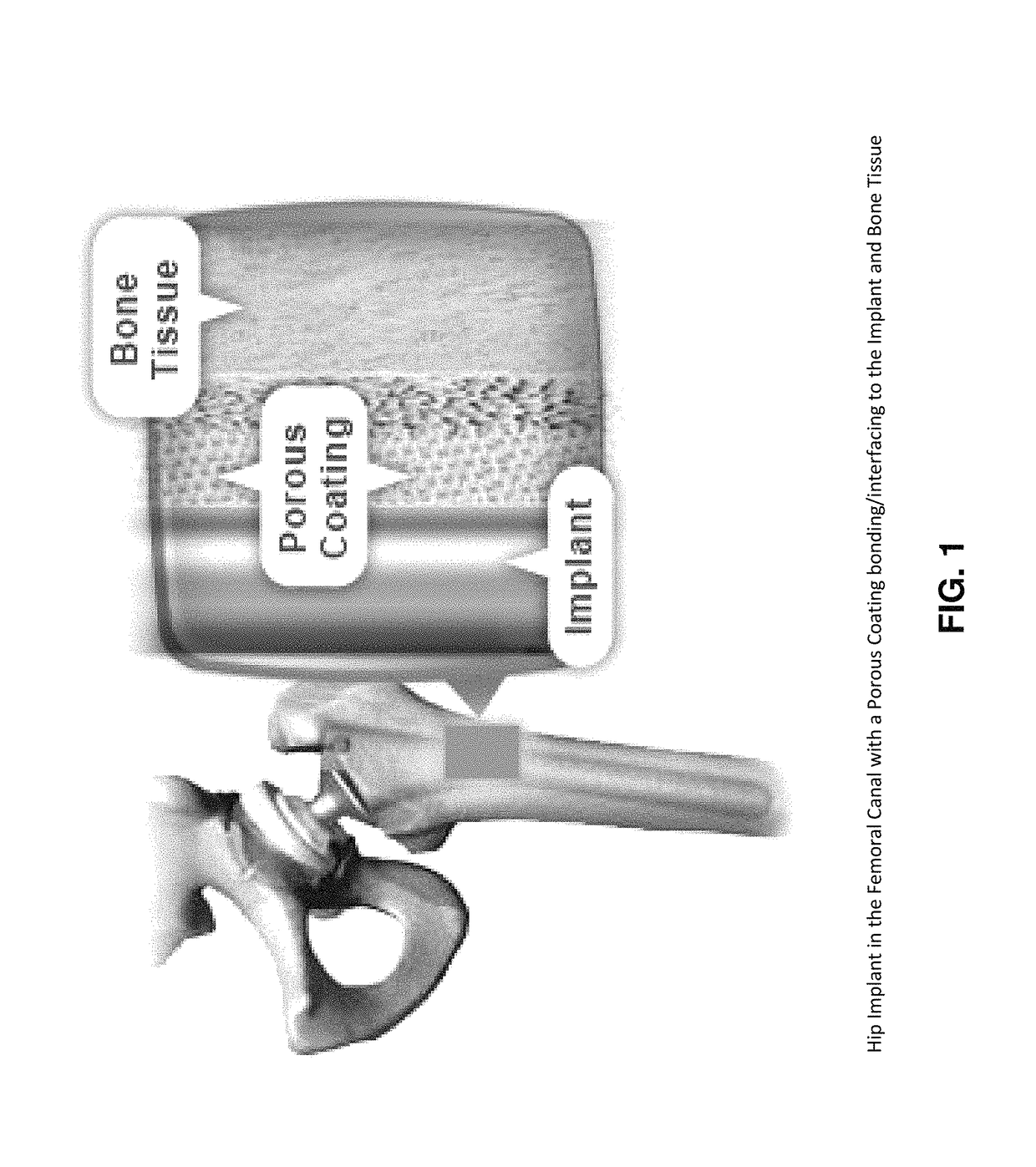 Porous coating for orthopedic implant utilizing porous, shape memory materials