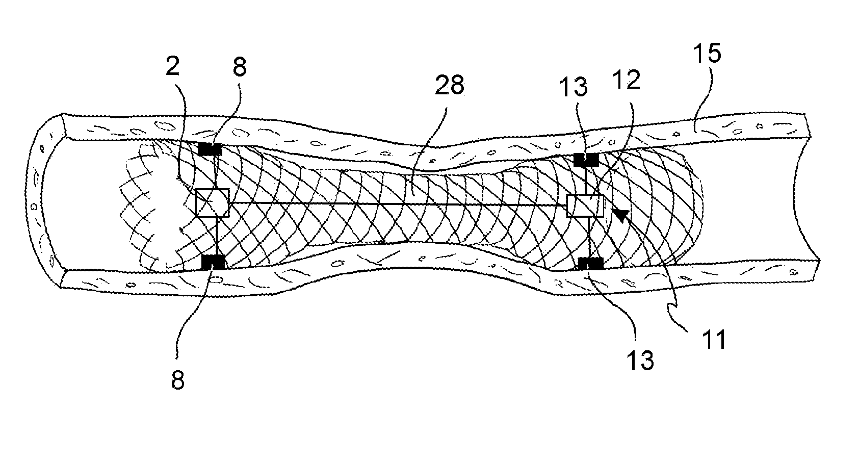 Devices and methods for the treatment of metabolic disorders