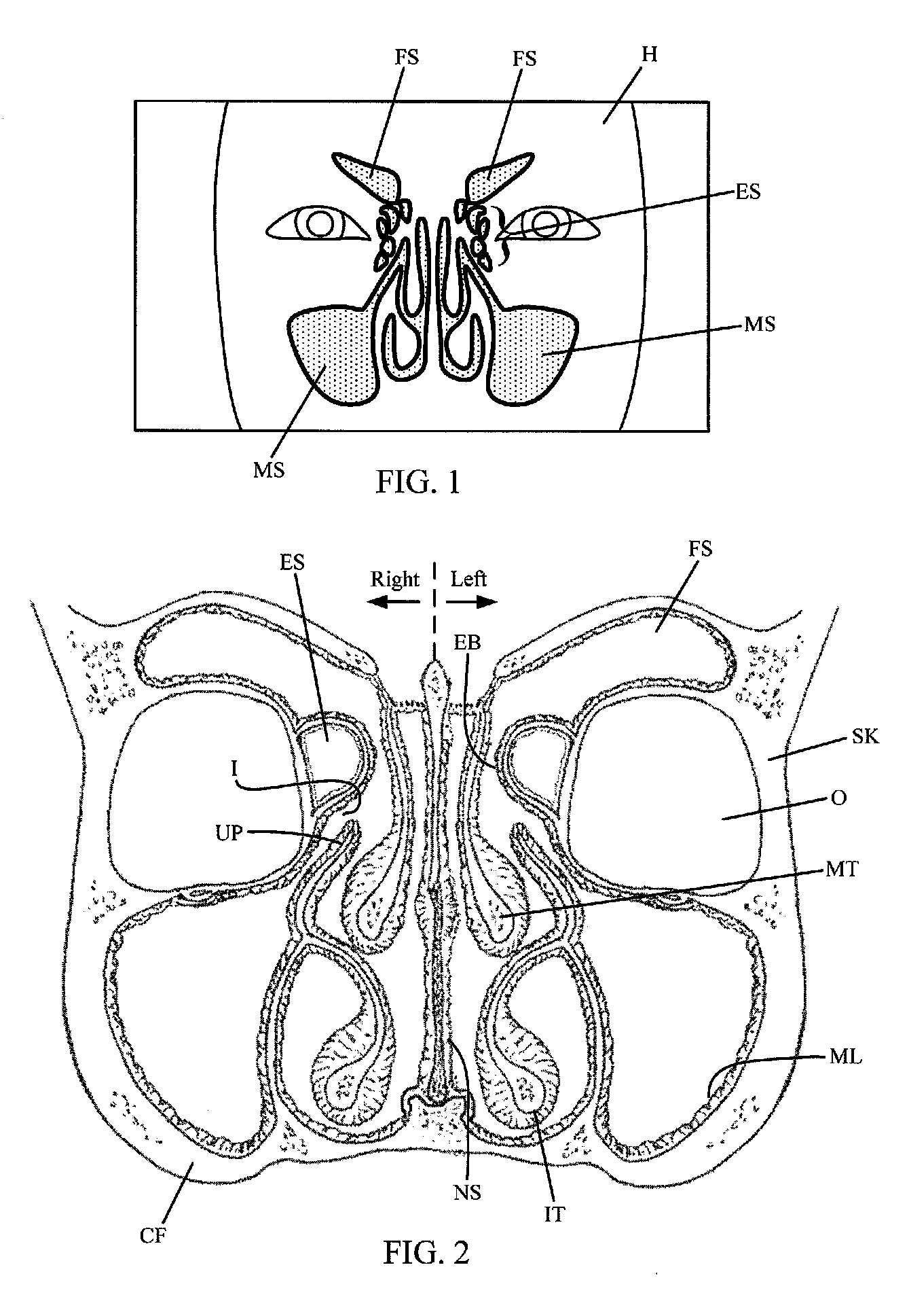 Device and method for treatment of sinusitus