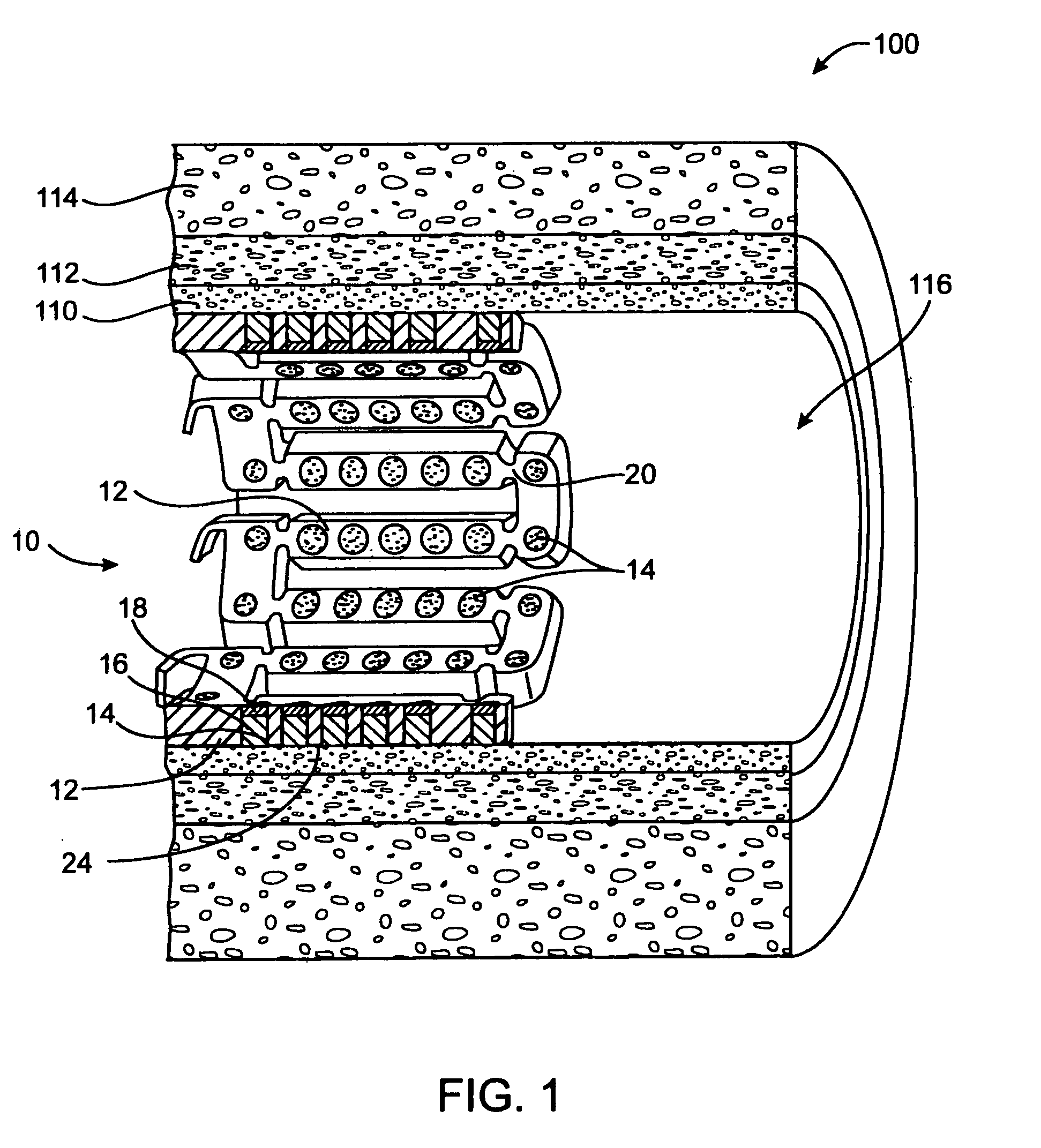 Expandable medical device and method for treating chronic total occlusions with local delivery of an angiogenic factor