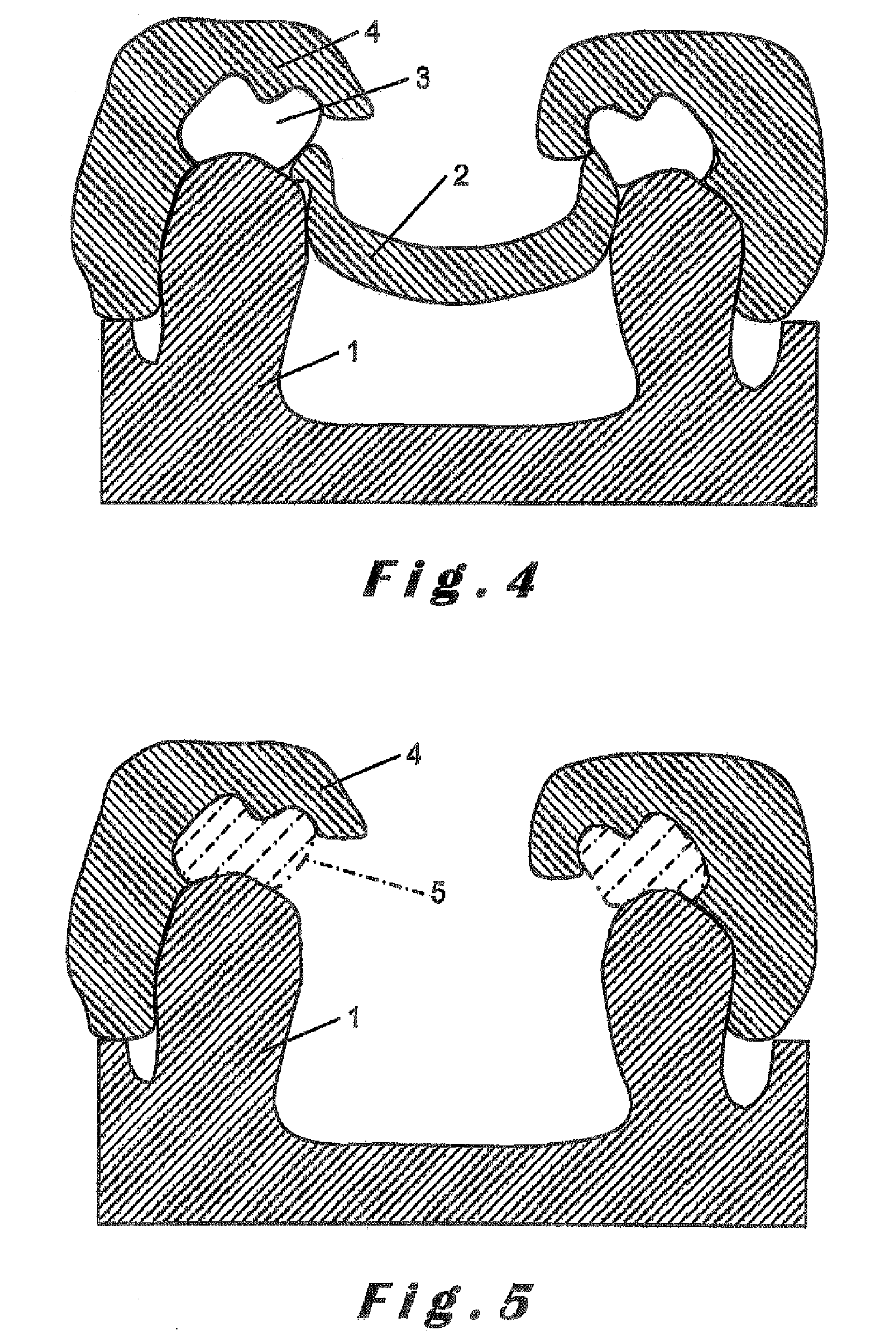 Method for manufacturing a dental prosthesis and an appliance for implantation thereof