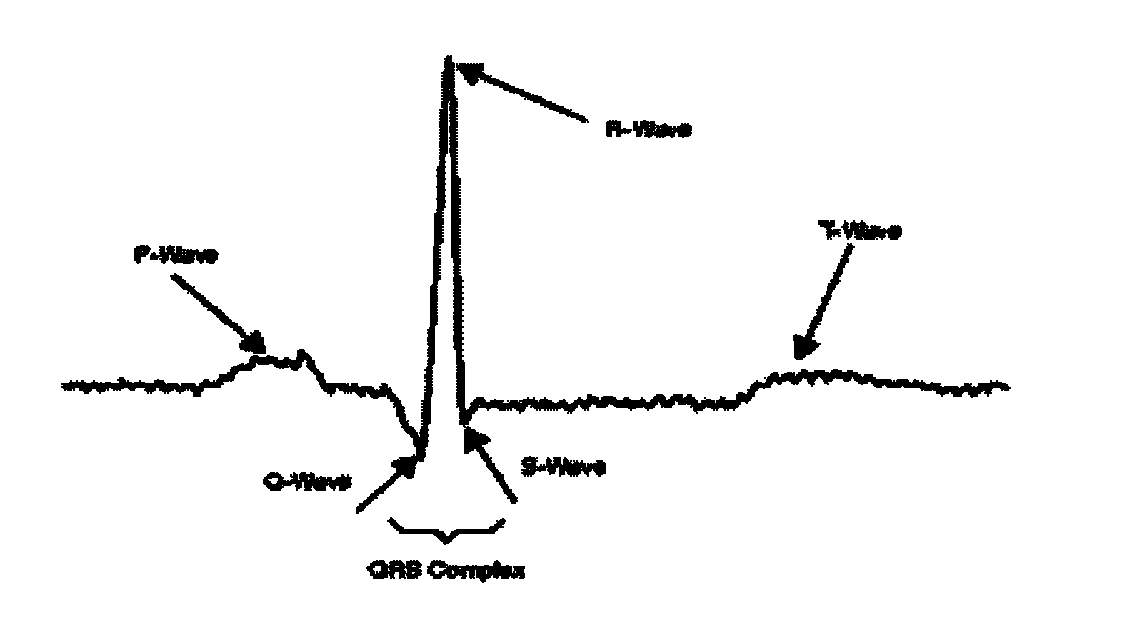 Method for detecting and locating R wave in QRS (Quantum Resonance Spectrometer) waves of electrocardiographic signals of mother and fetus