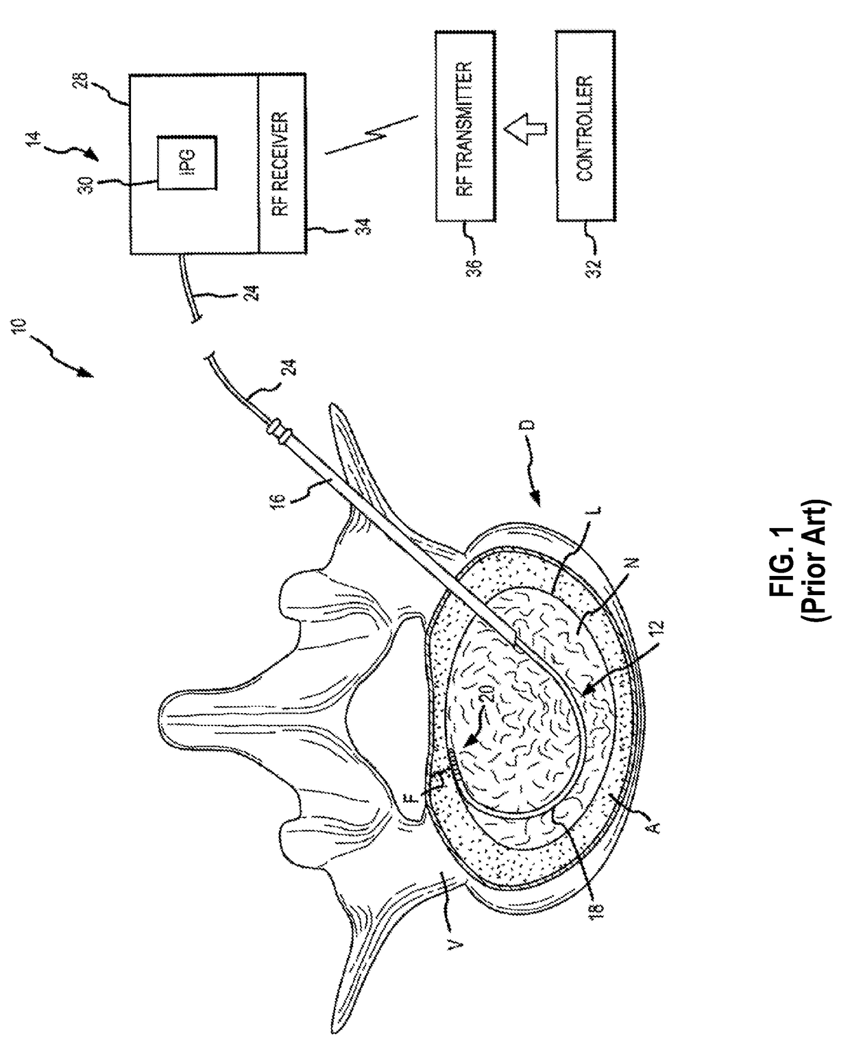 Adjustable length tension sleeve for electrical or thermal stimulation device