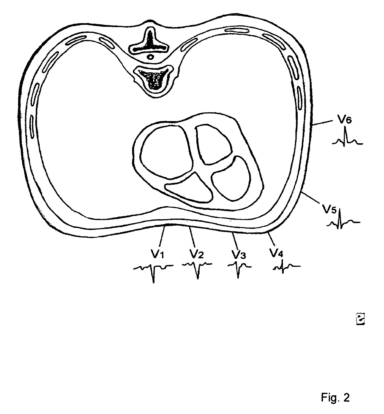 Method of finding the source of and treating cardiac arrhythmias