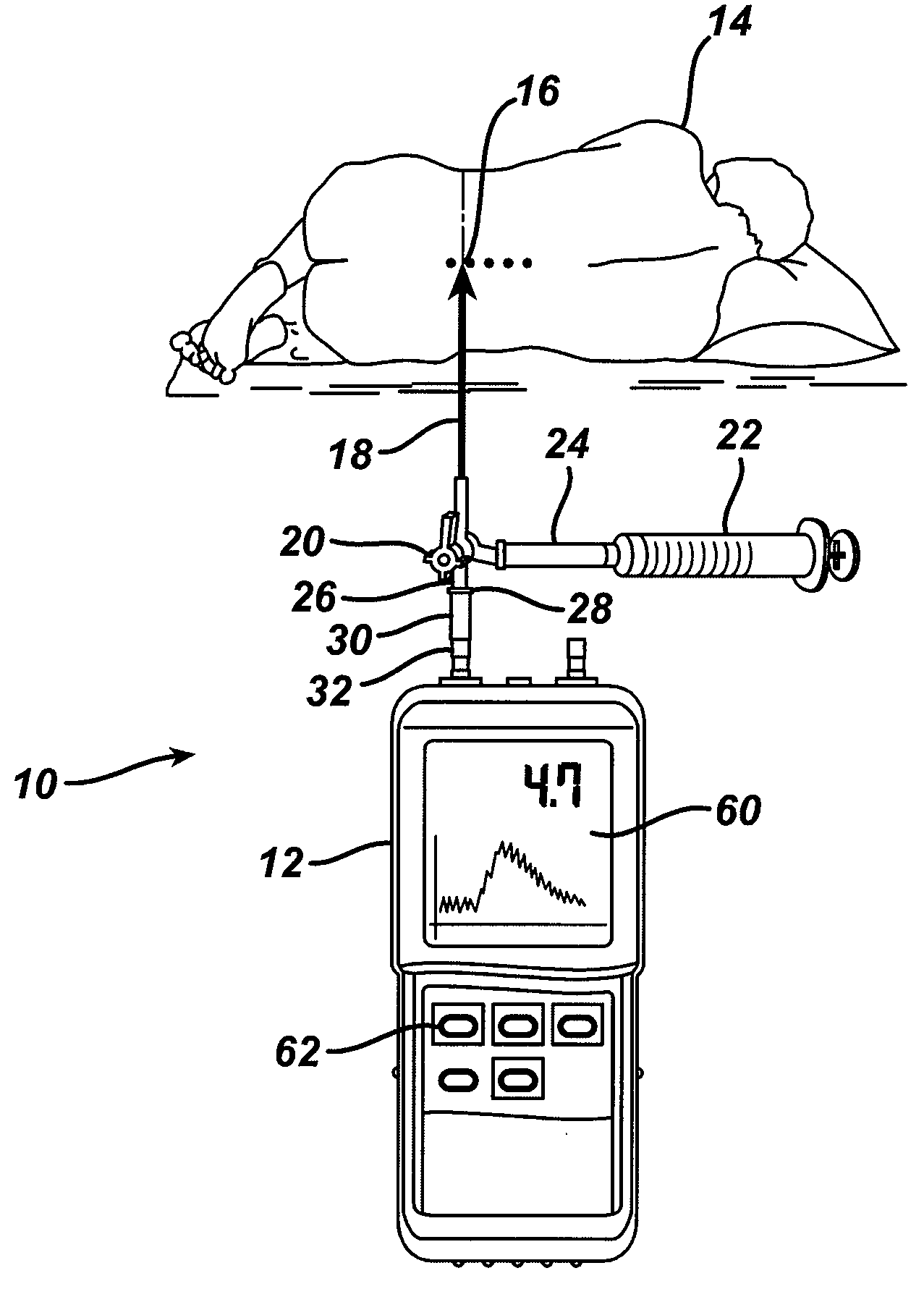 System and Method for Measuring the Pressure of a Fluid System Within a Patient