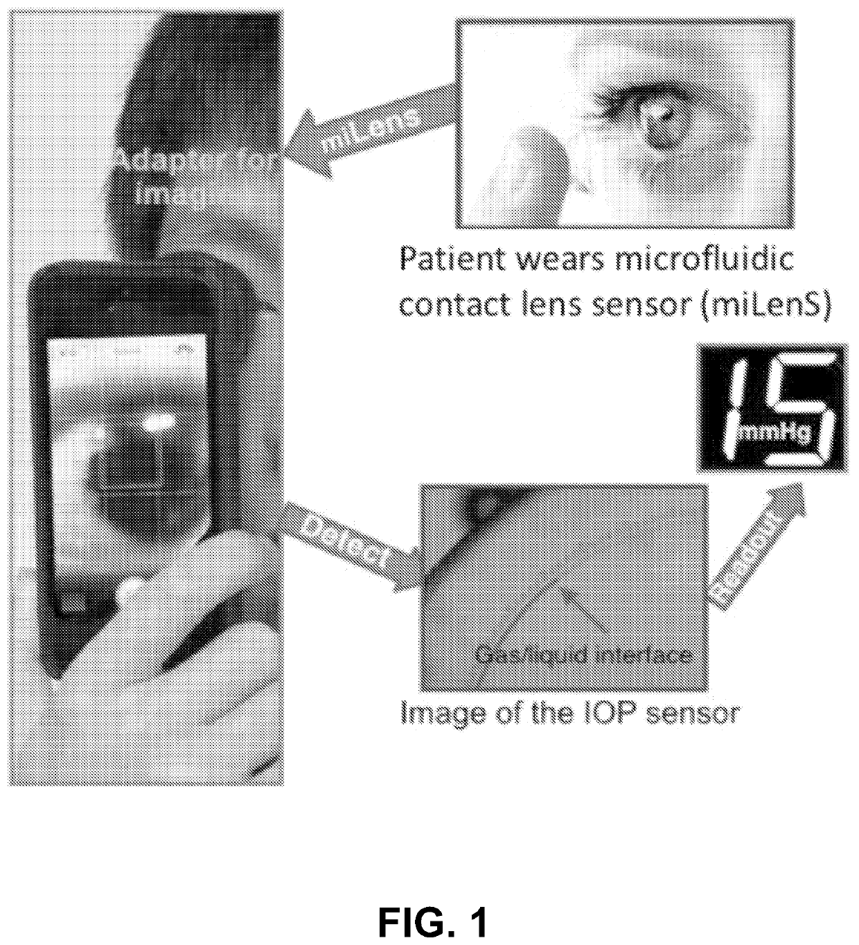 Closed microfluidic network for strain sensing embedded in a contact lens to monitor intraocular pressure