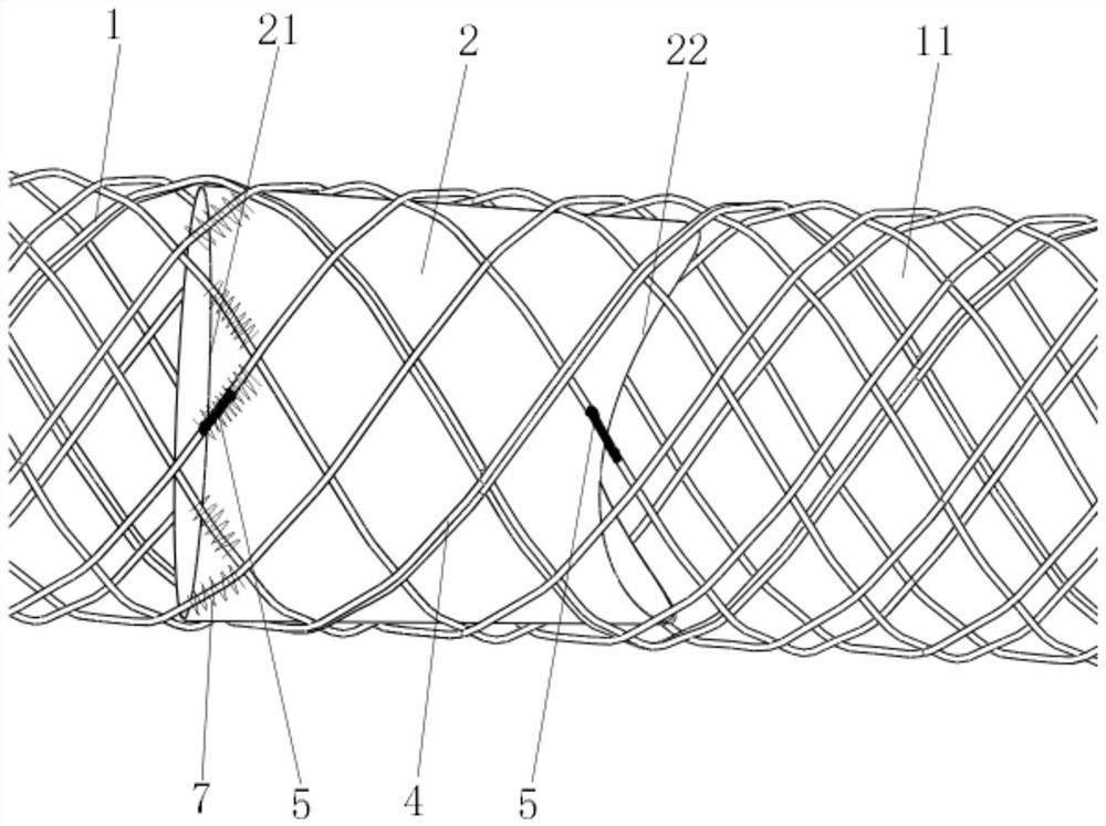Membrane-carrying stent