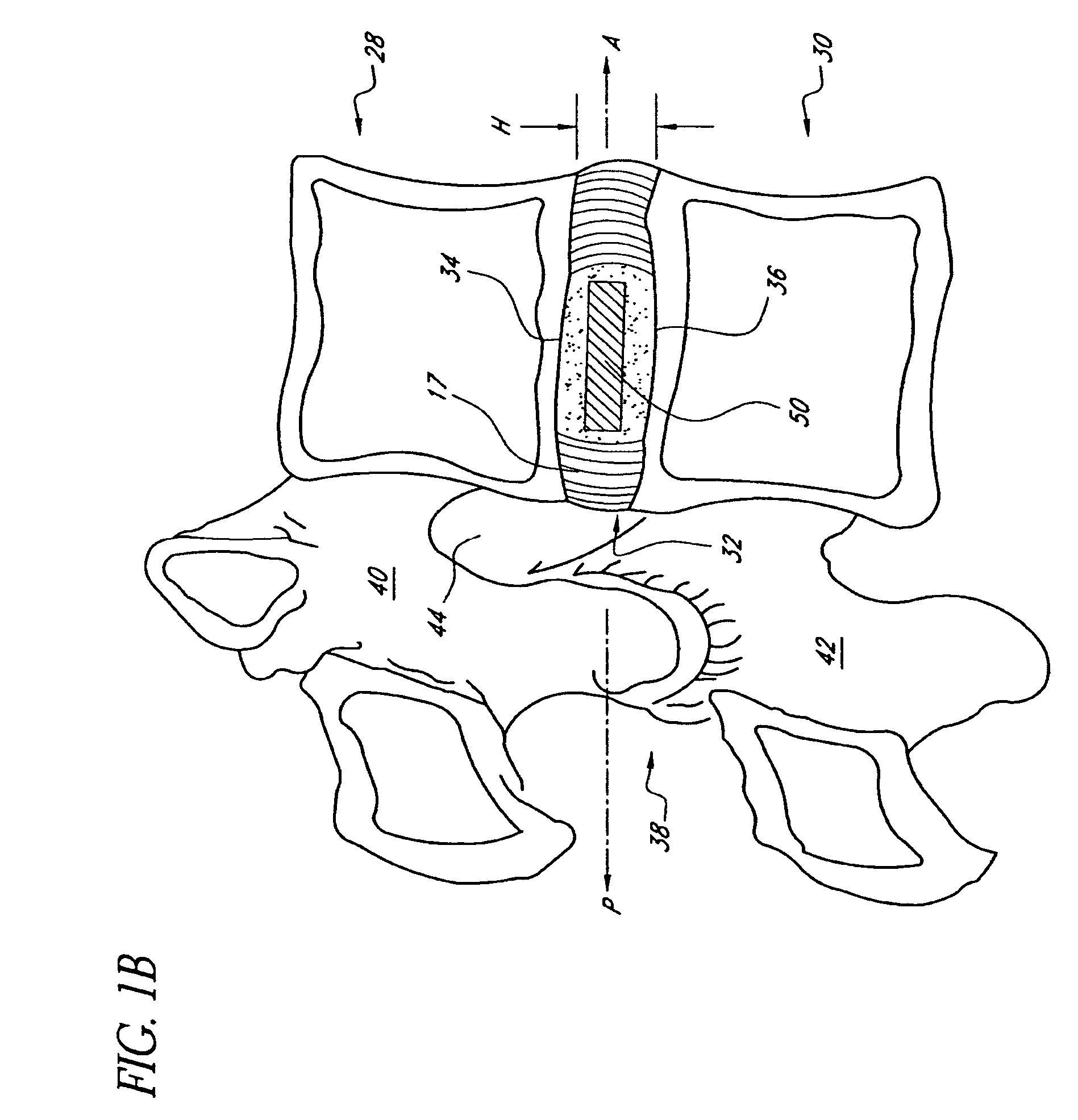 Method of treating a herniated disc