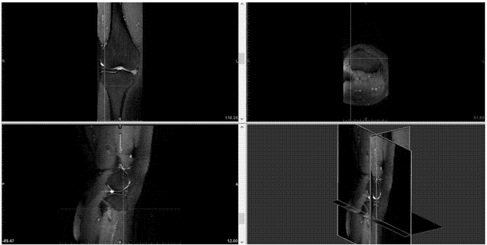 Knee-joint discoid meniscus surgery simulation method