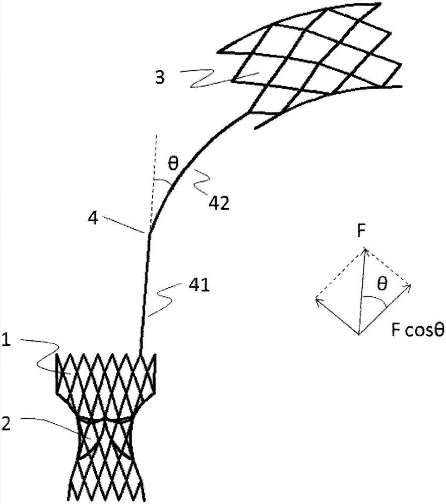 Pulmonary valve stent with anchoring mechanism