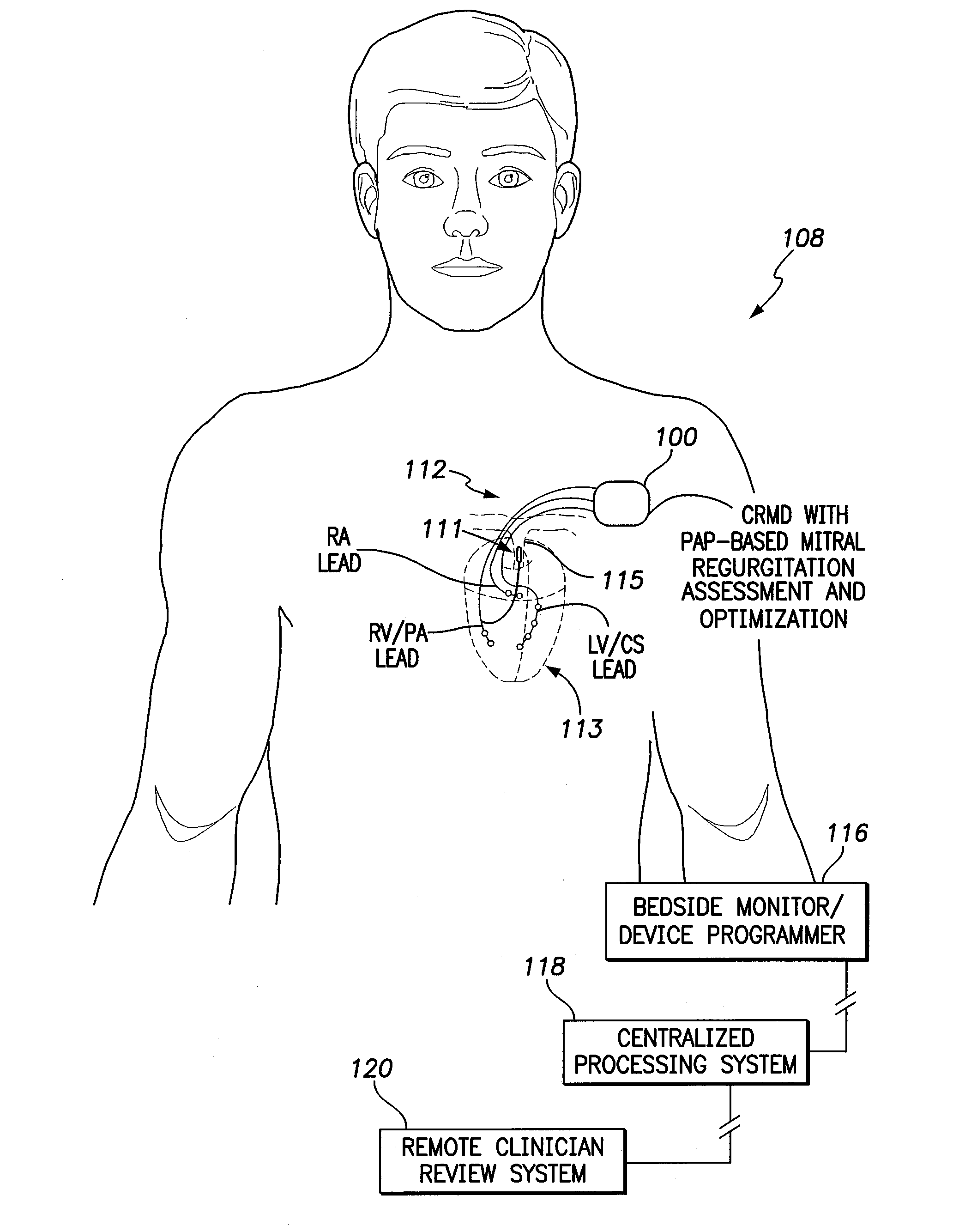 Systems and methods for using pulmonary artery pressure from an implantable sensor to detect mitral regurgitation and optimize pacing delays