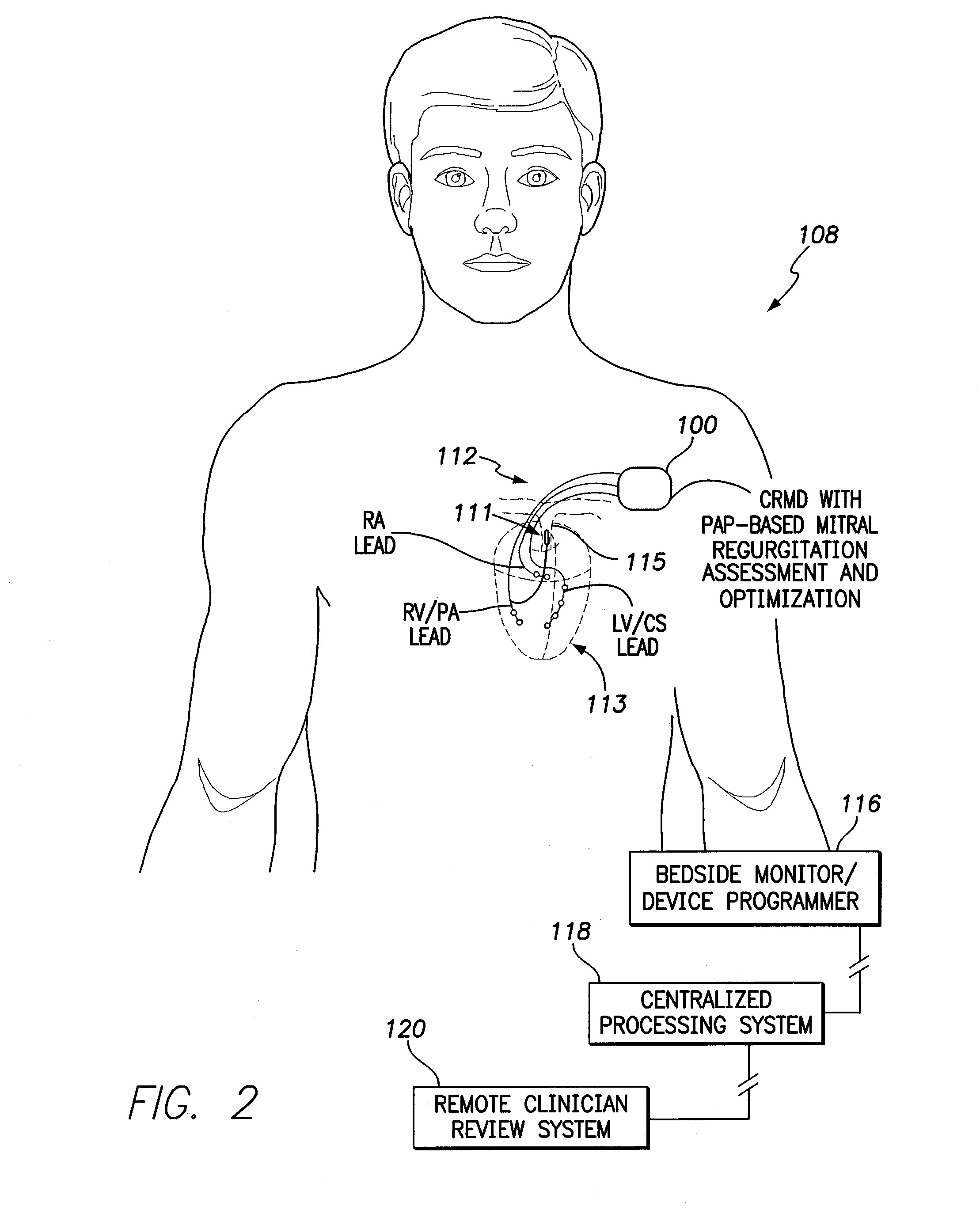 Systems and methods for using pulmonary artery pressure from an implantable sensor to detect mitral regurgitation and optimize pacing delays