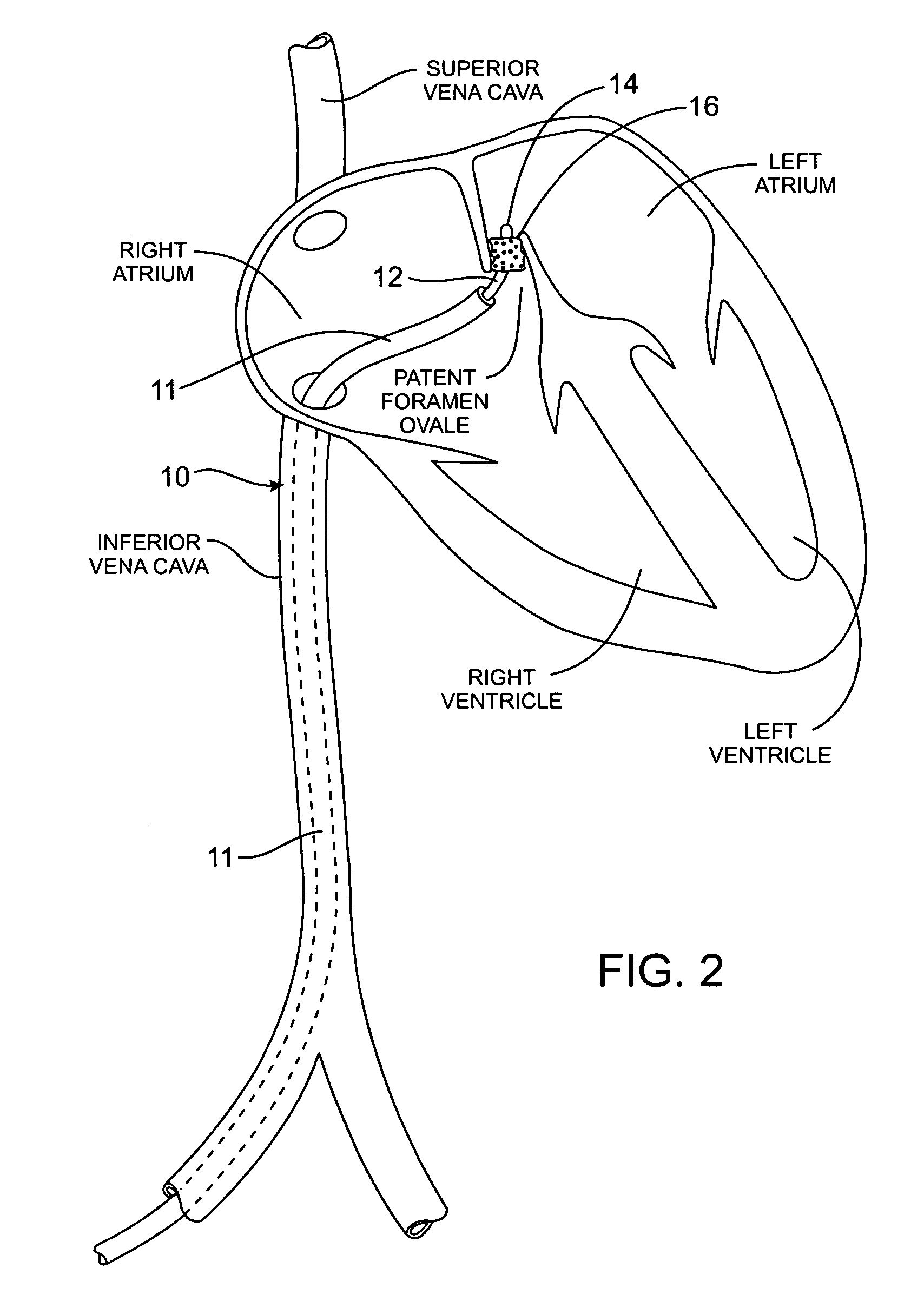 Methods and apparatus for treatment of patent foramen ovale