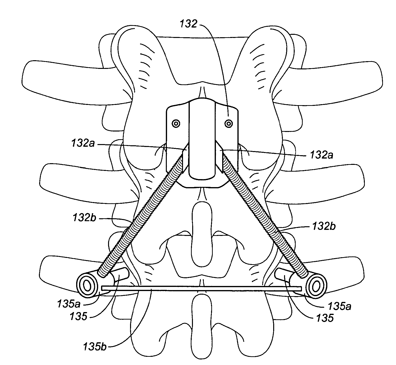 Device and method for correcting a spinal deformity