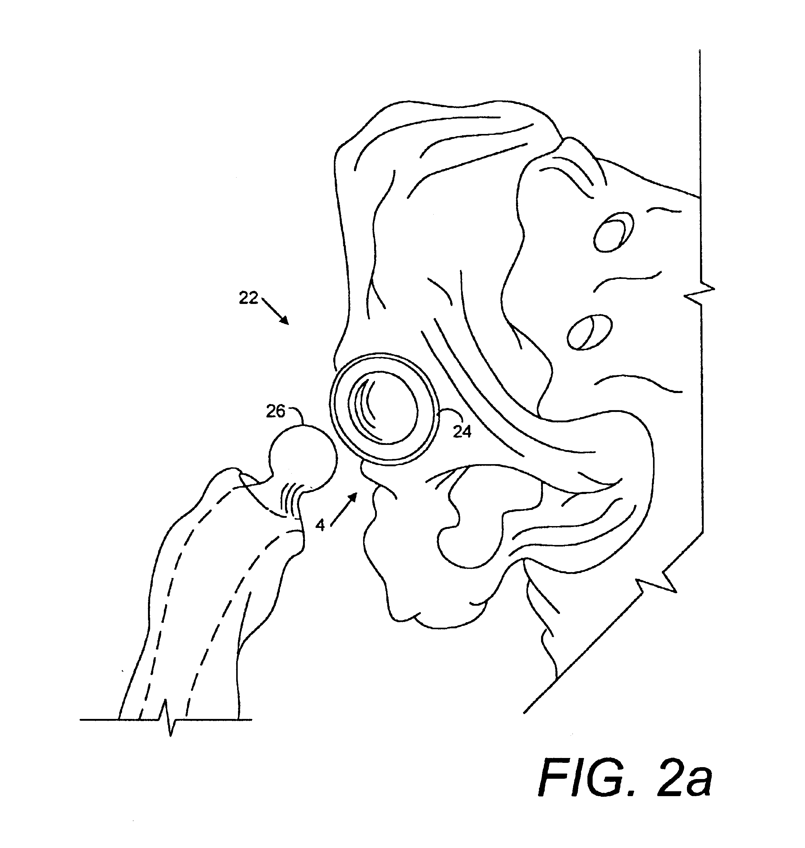 Porous implant system and treatment method