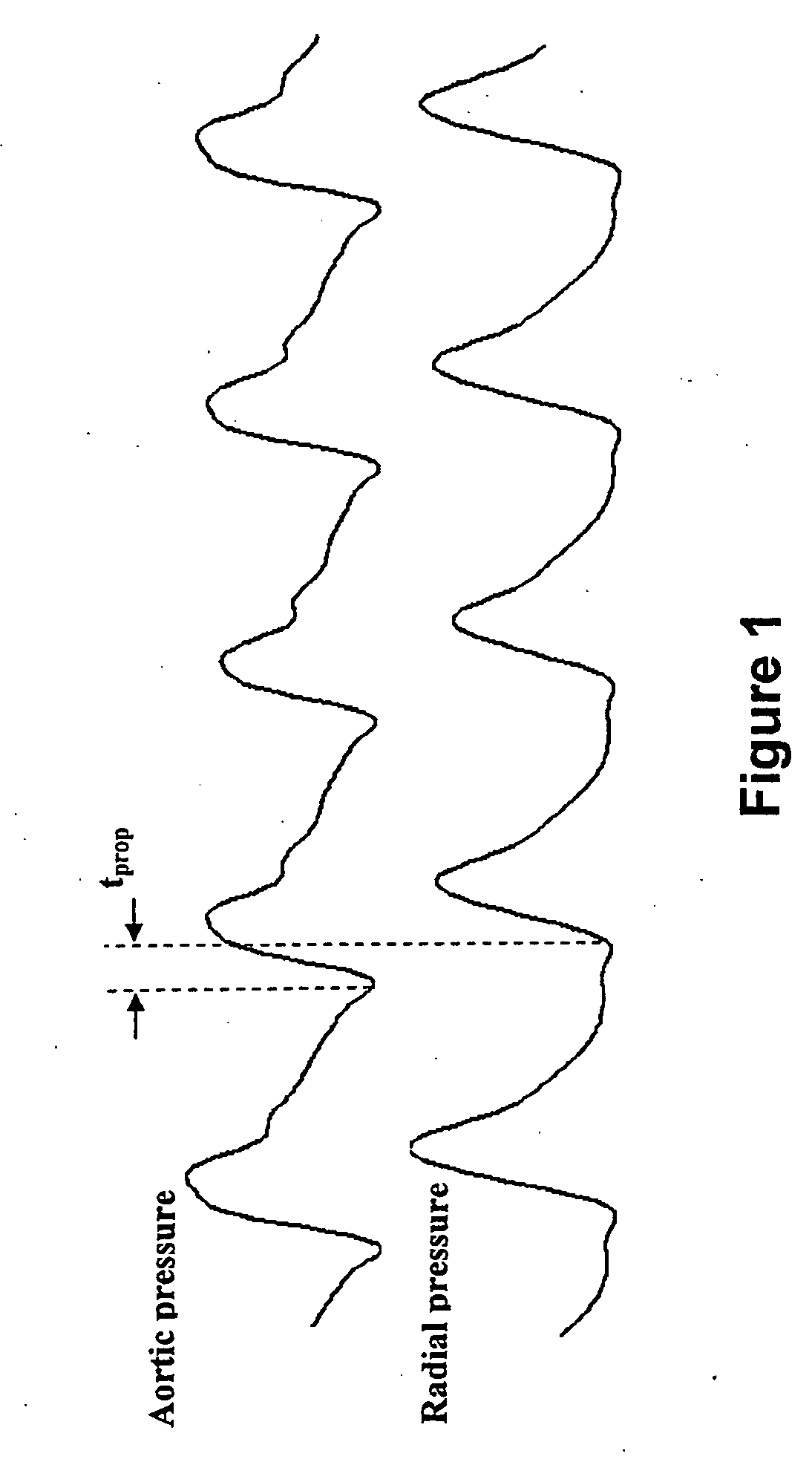 Method and apparatus for continuous assessment of a cardiovascular parameter using the arterial pulse pressure propagation time and waveform