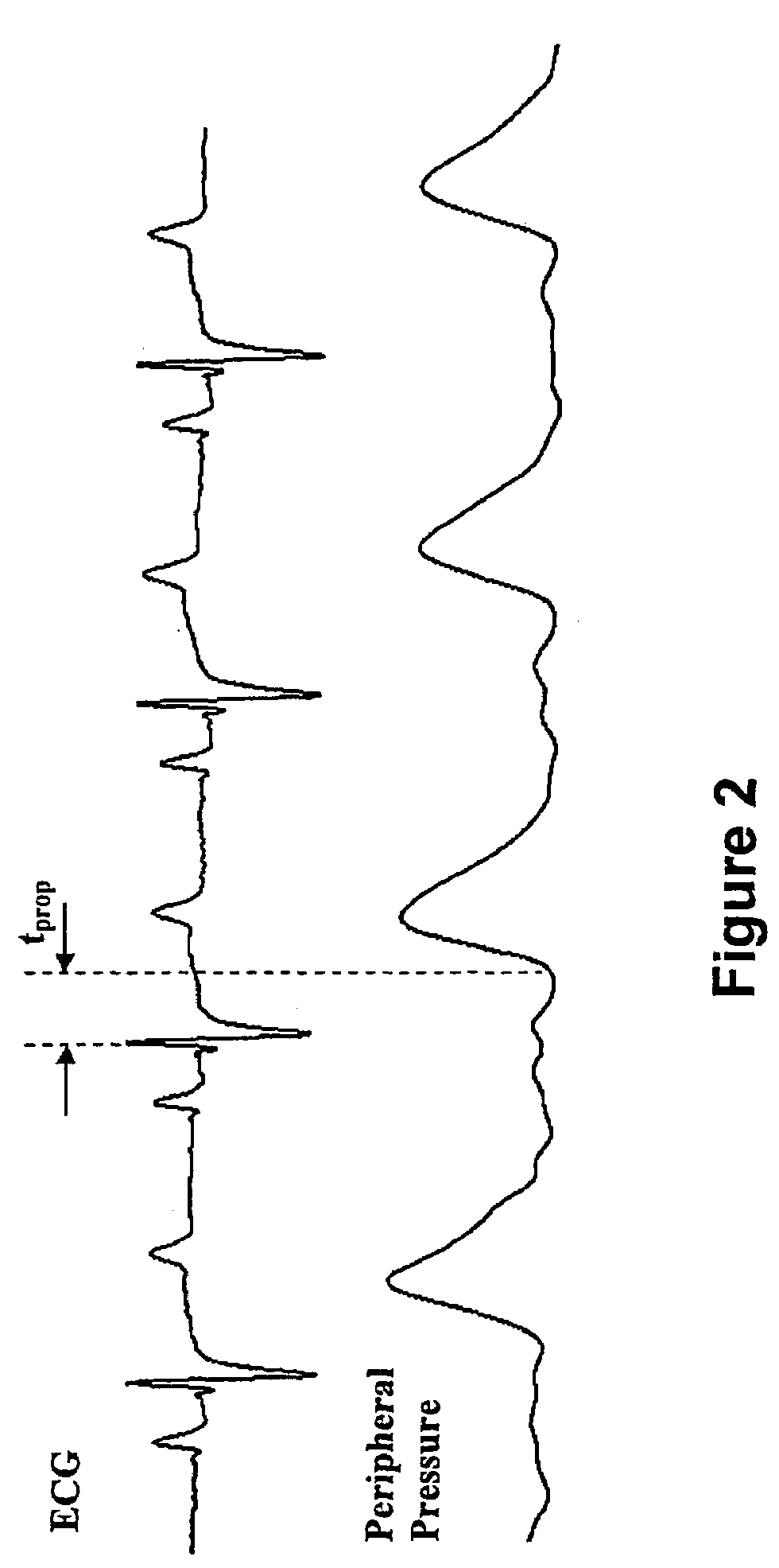 Method and apparatus for continuous assessment of a cardiovascular parameter using the arterial pulse pressure propagation time and waveform
