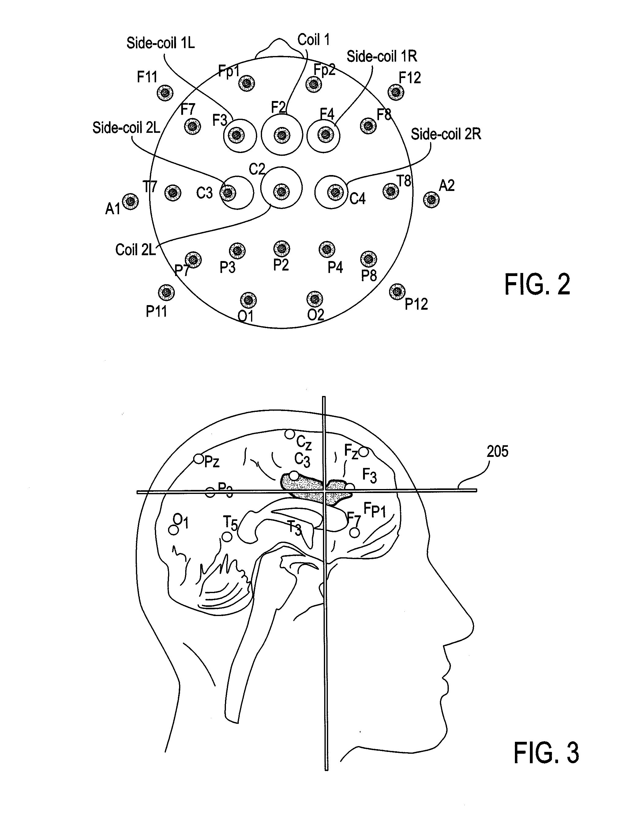 Transcranial magnetic stimulation field shaping