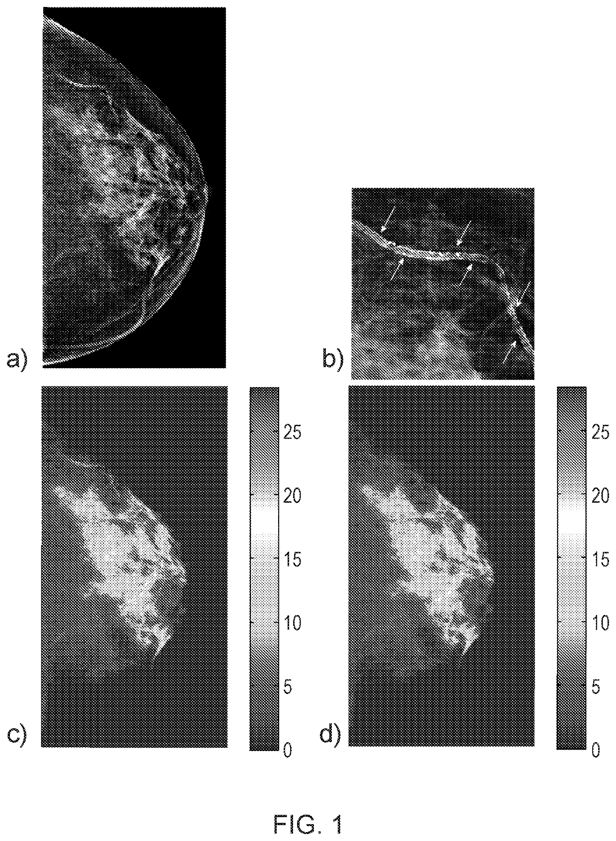 Method for detection and quantification of arterial calcification