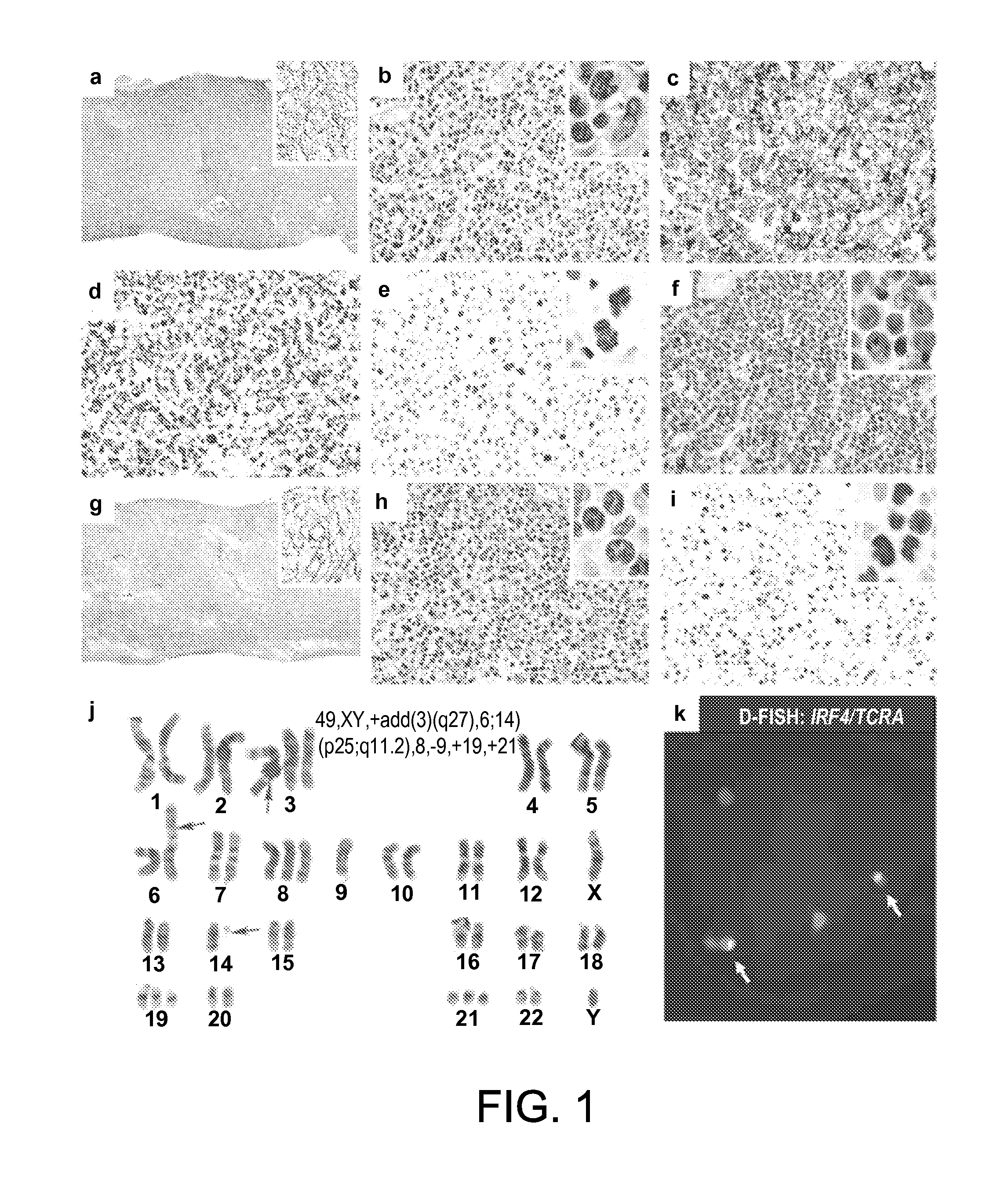 Reducing irf4, dusp22, or flj43663 polypeptide expression