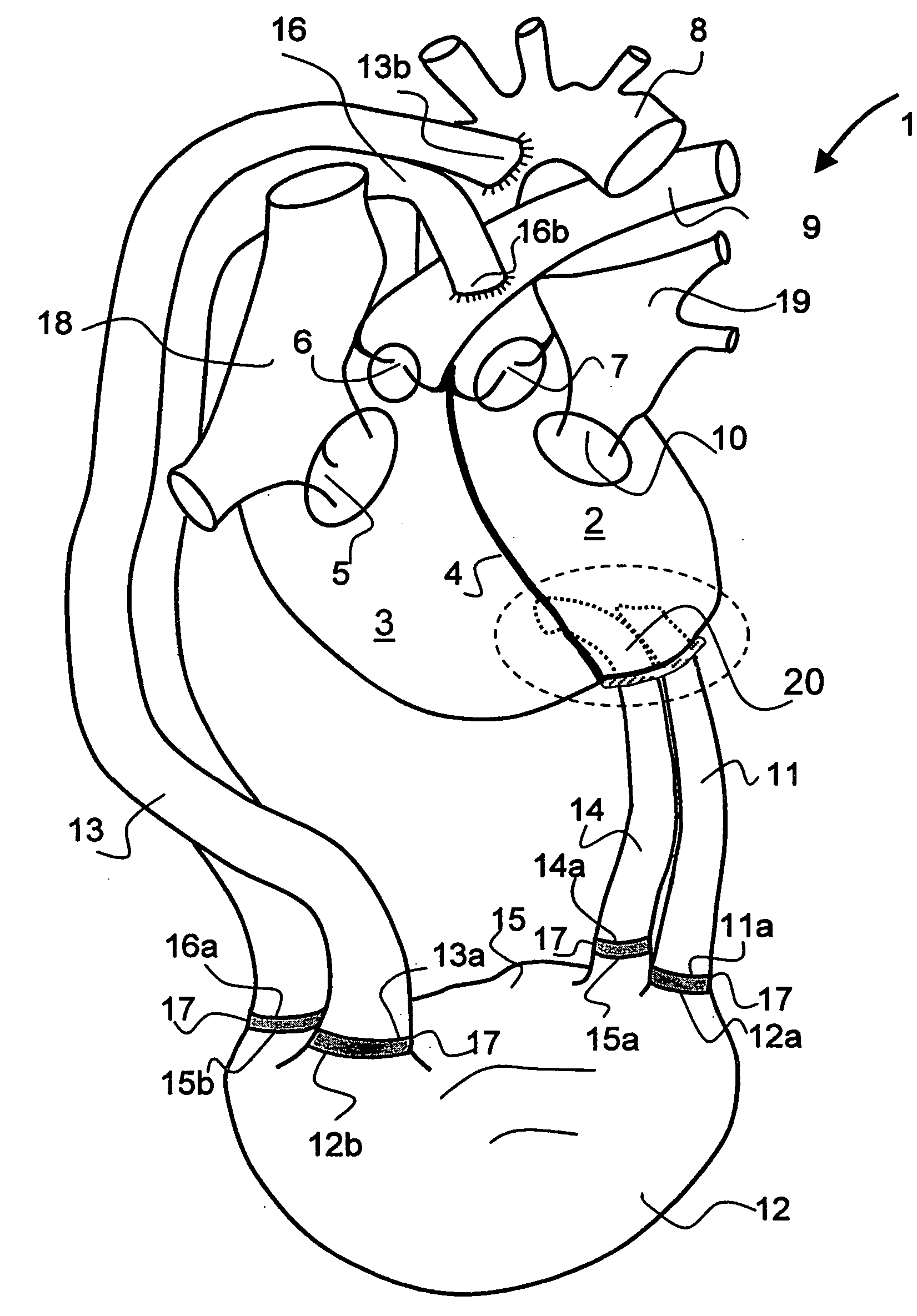 Device for connecting a cardiac biventricular assist means