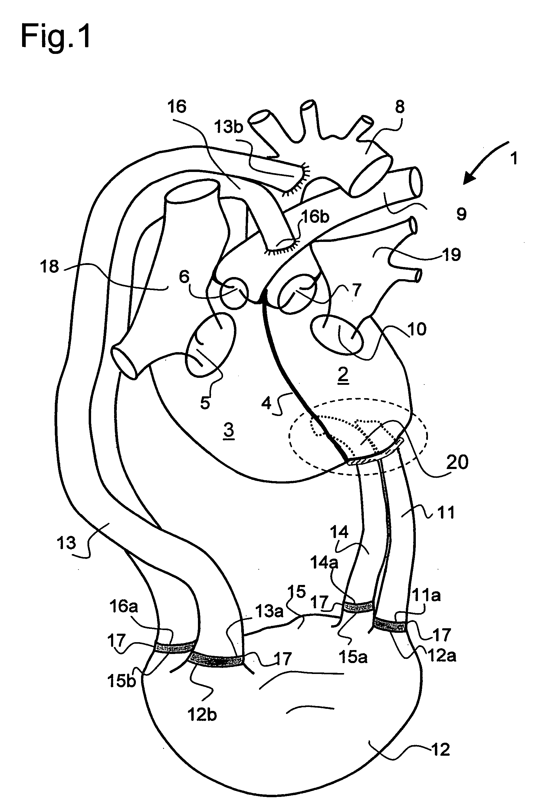 Device for connecting a cardiac biventricular assist means