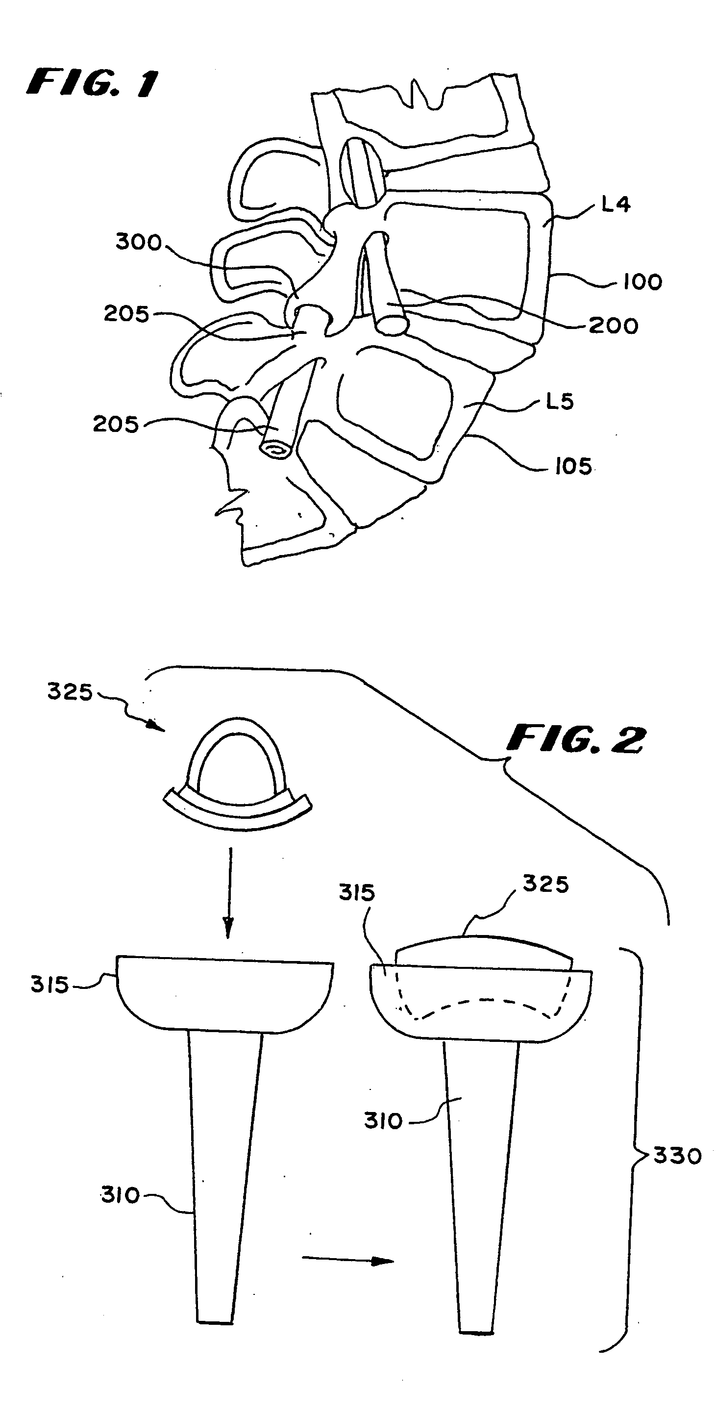Facet arthroplasty devices and methods