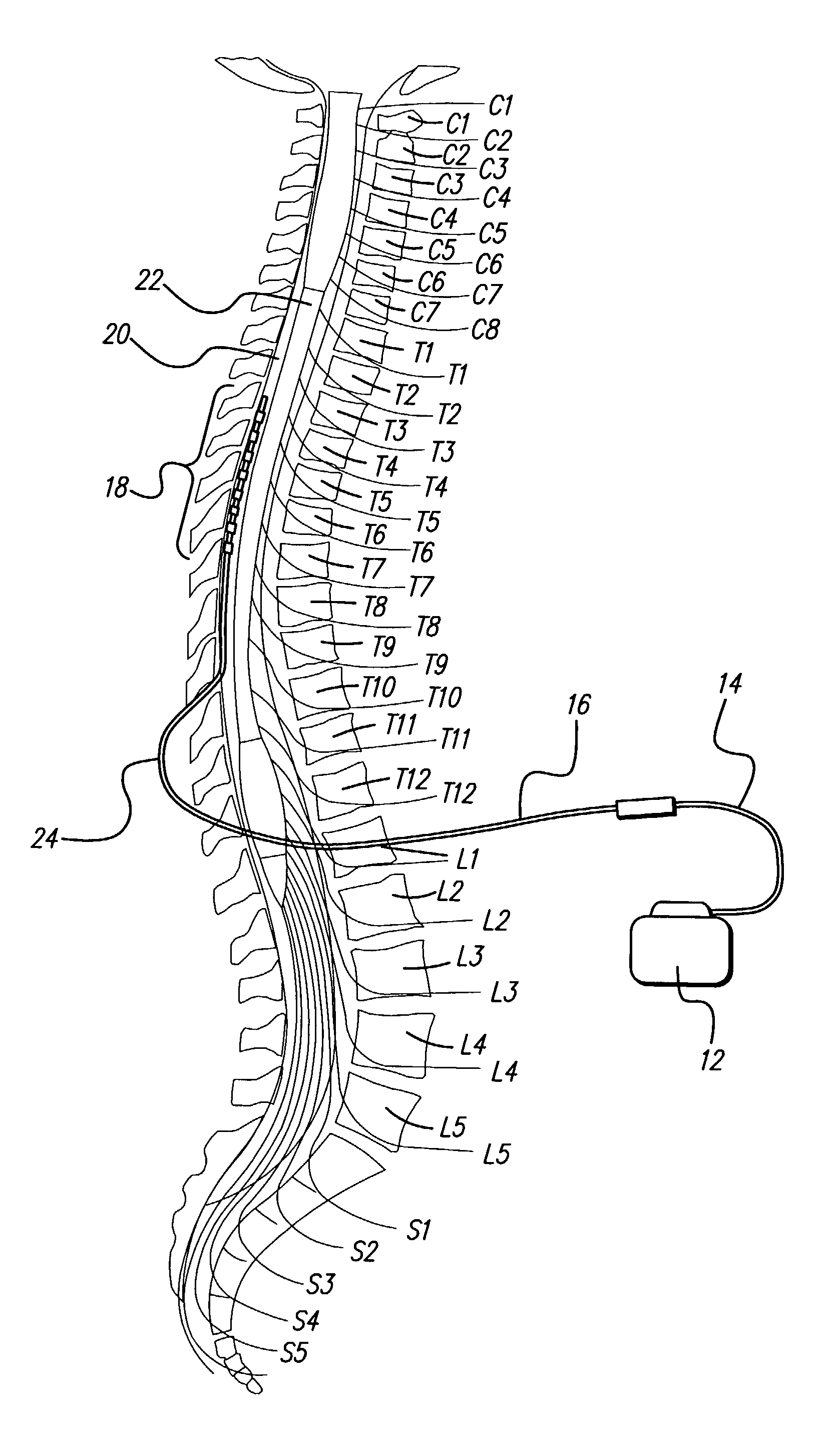 Method for increasing the therapeutic ratio/usage range in a neurostimulator