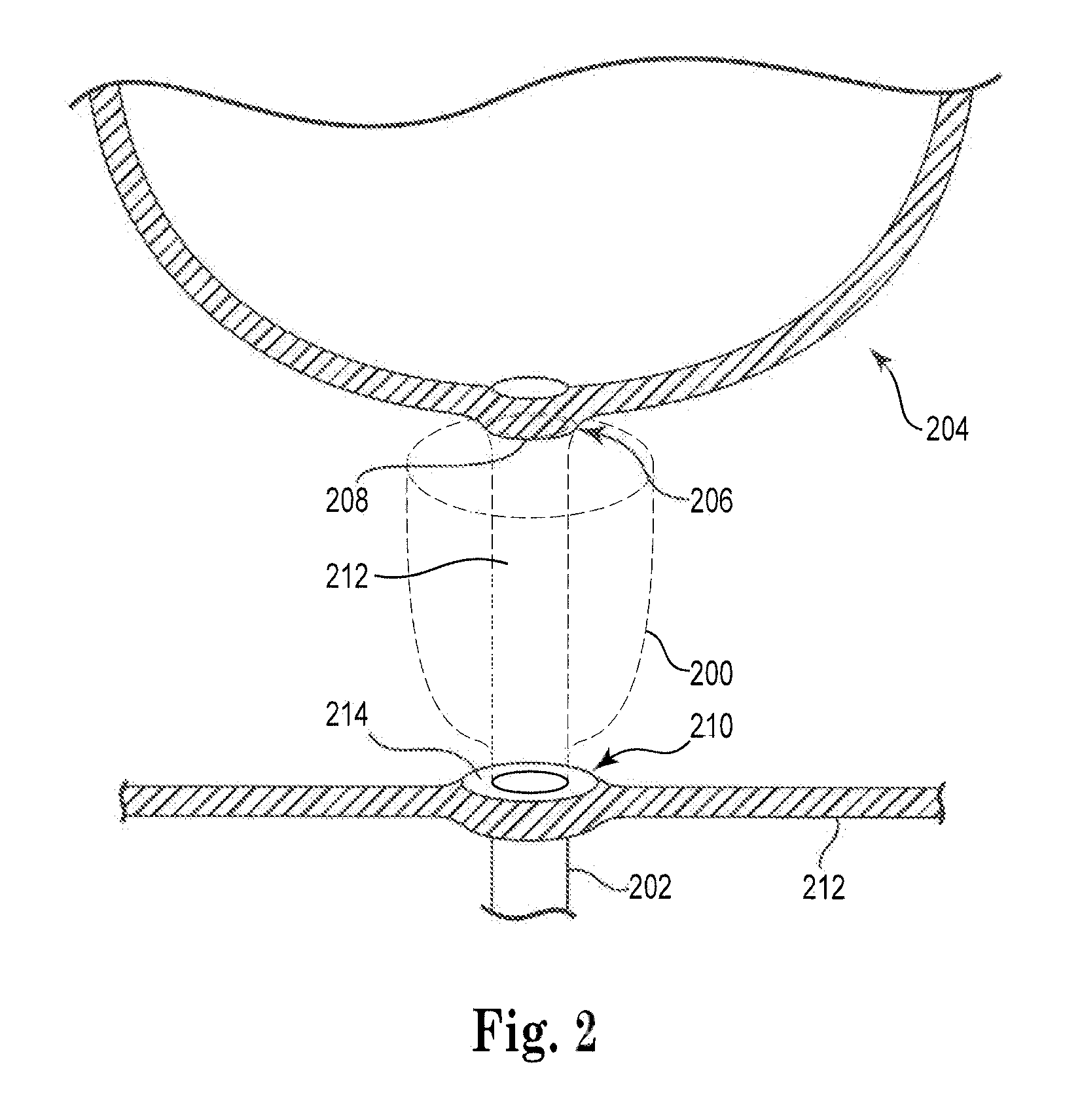 Anastomosis device and related methods