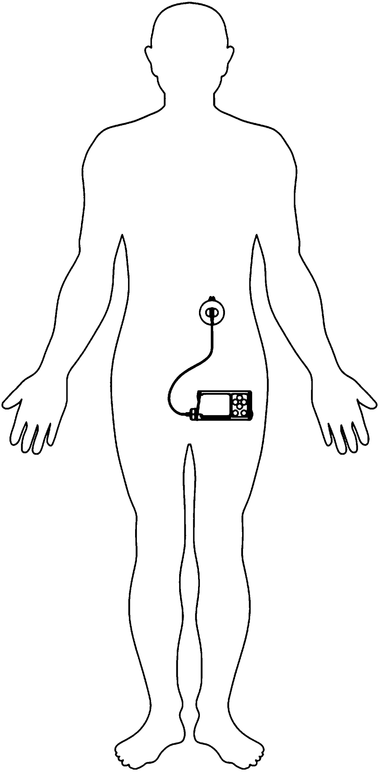 Novel infusion pipeline for insulin pump and micro-infusion pump