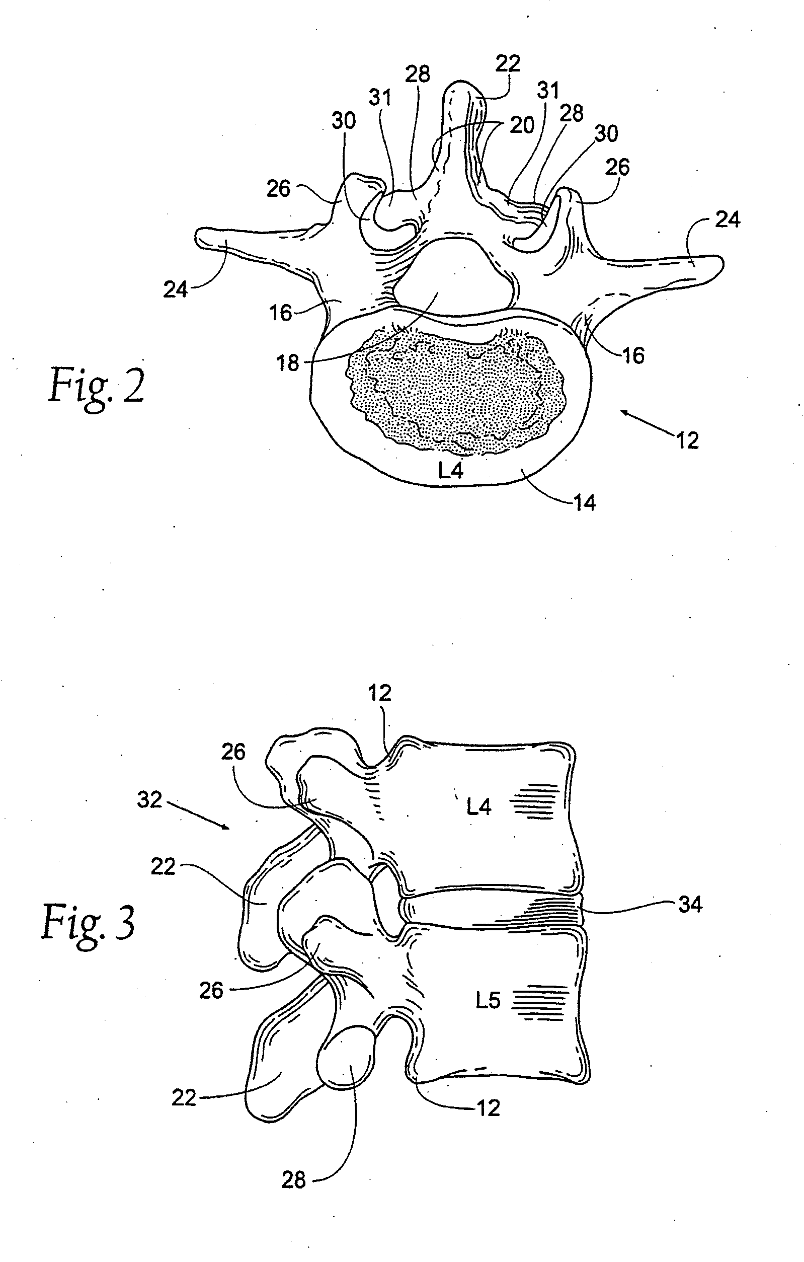 Prostheses, Systems and Methods for Replacement of Natural Facet Joints With Artificial Facet Joint Surfaces