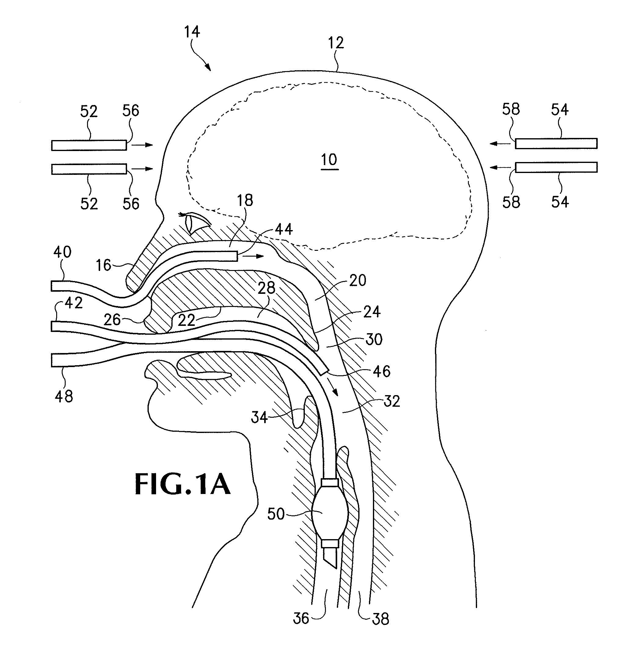 Rapid Cooling of Body and/or Brain by Irrigating with a Cooling Liquid