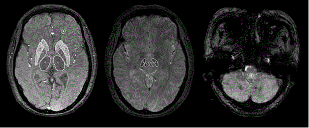 Noninvasive method for determining iron content in brain tissue