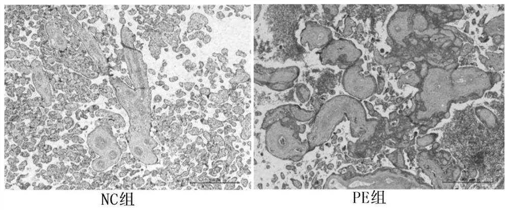 Long noncoding RNA (lncRNA) for clinical risk assessment of preeclampsia (PE) and application of lncRNA