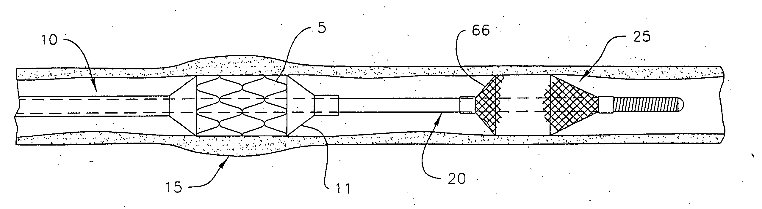 Guidewire apparatus for temporary distal embolic protection