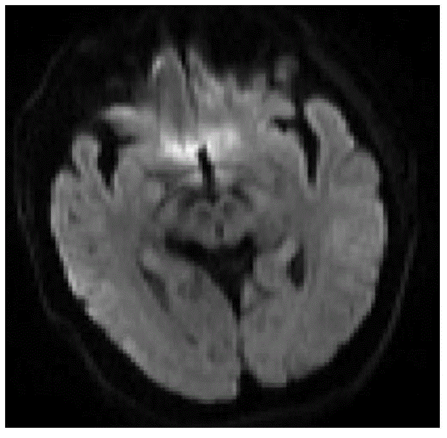 Analyzing and processing method for analyzing and processing magnetic resonance image of acute ischemic stroke