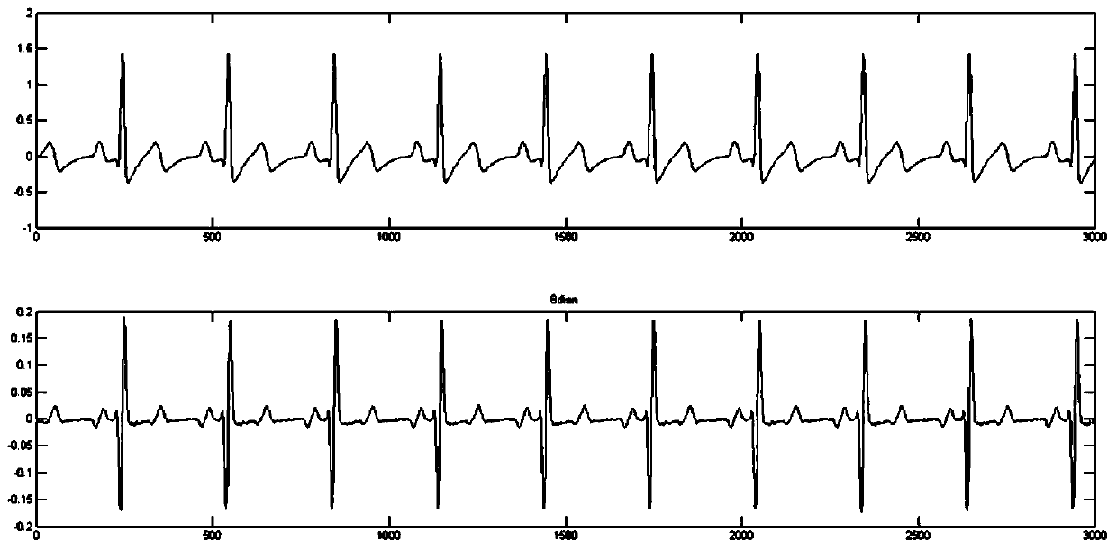 Extraction method of electrocardiosignal R waves