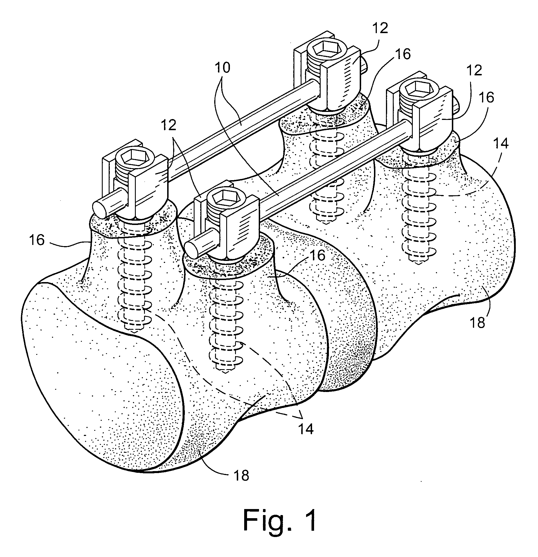 Apparatus and method for flexible spinal fixation