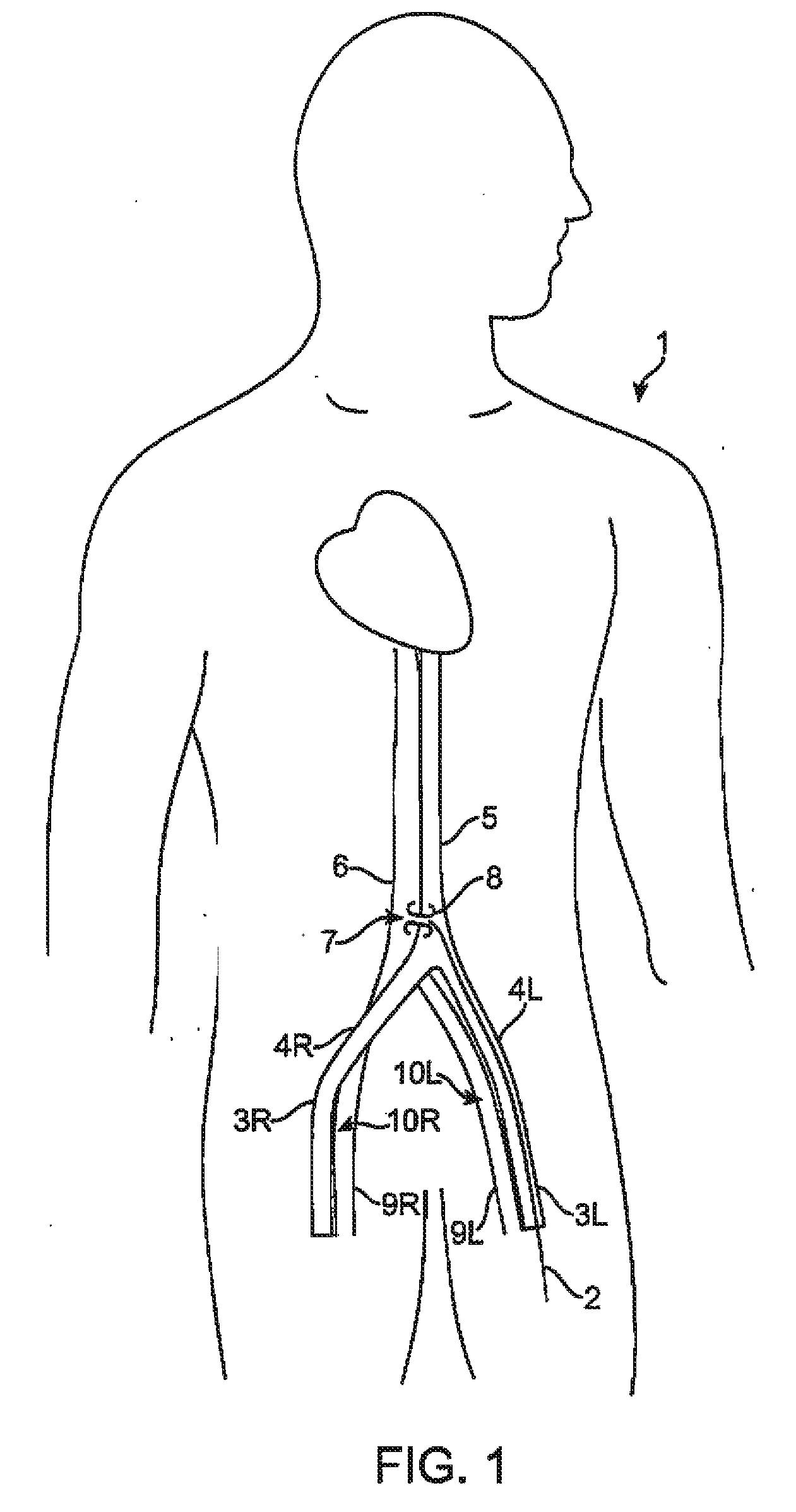 Device and method for establishing an artificial arterio-venous fistula